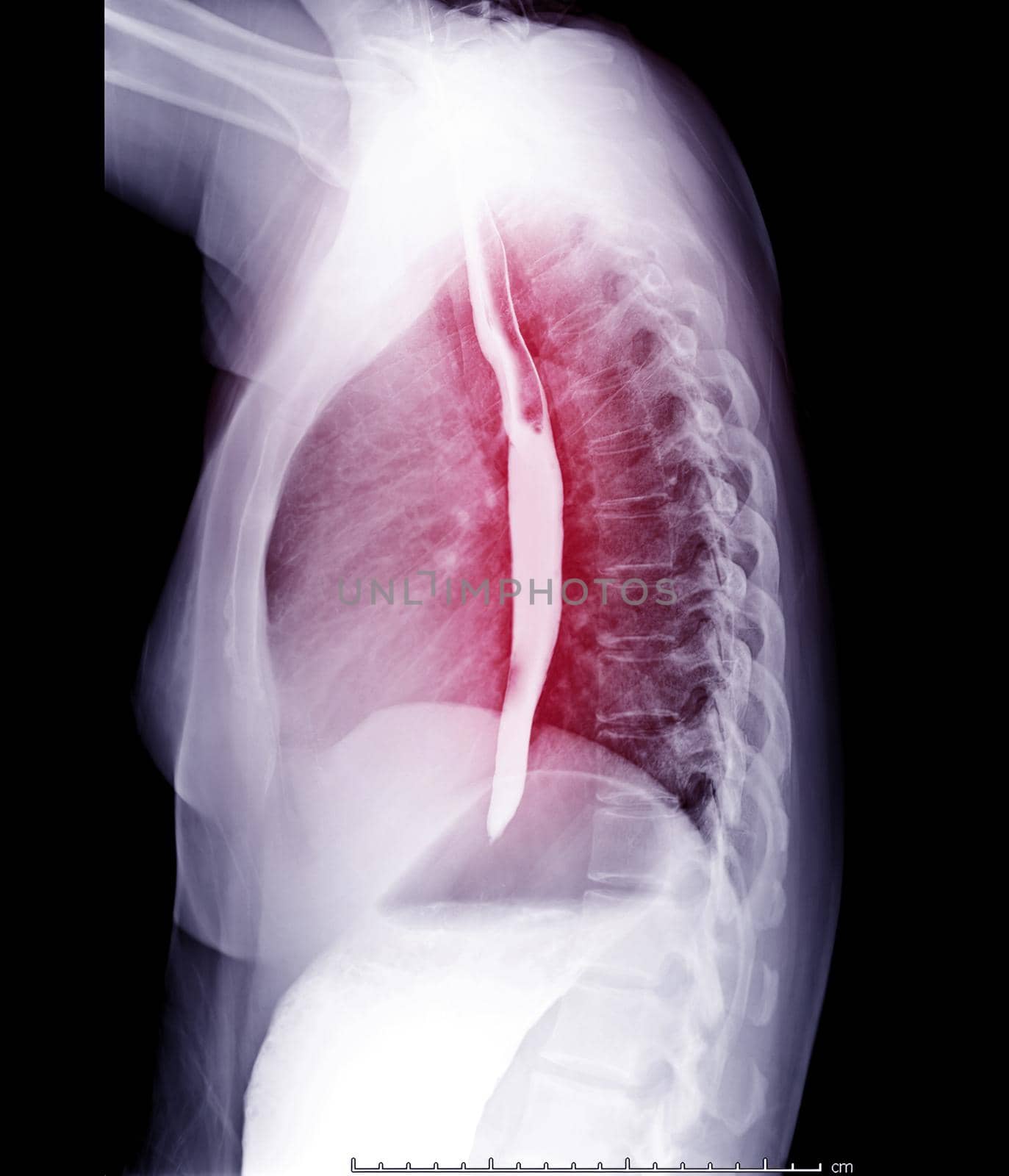 Esophagram or Barium swallow Lateral view for diagnosis GERD or Gastroesophageal reflux disease.