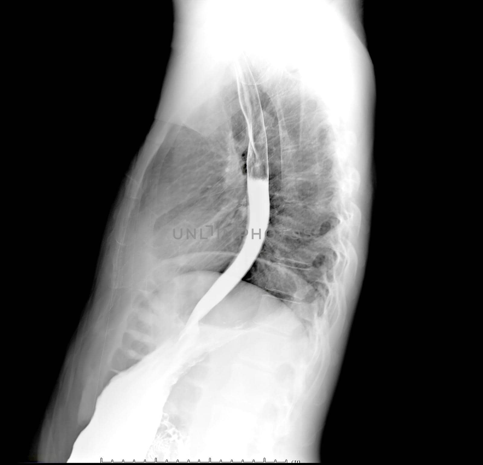 Esophagram or Barium swallow Lateral view showing esophagus.