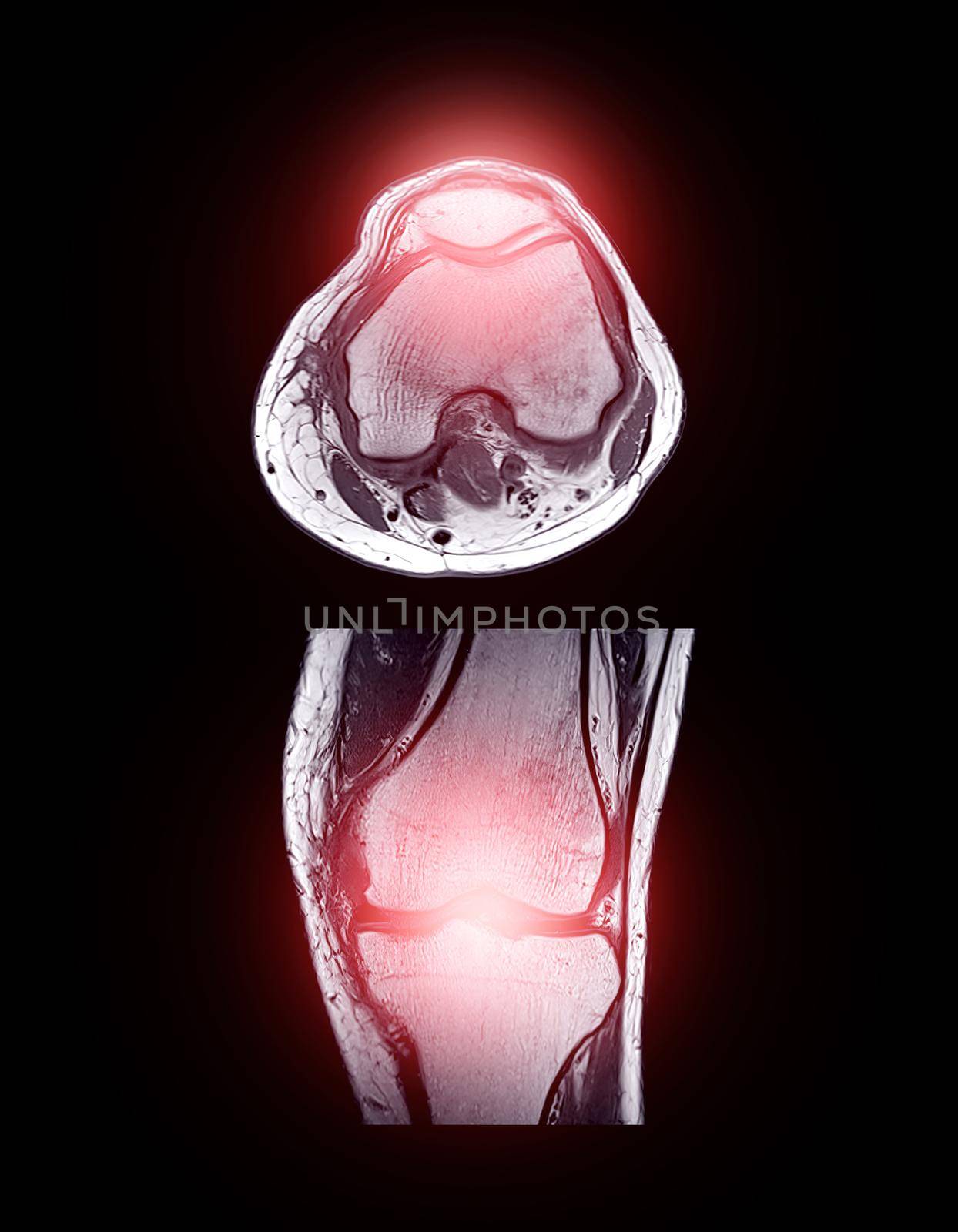 MRI knee joint or Magnetic resonance imaging comparison Axial and coronal view.