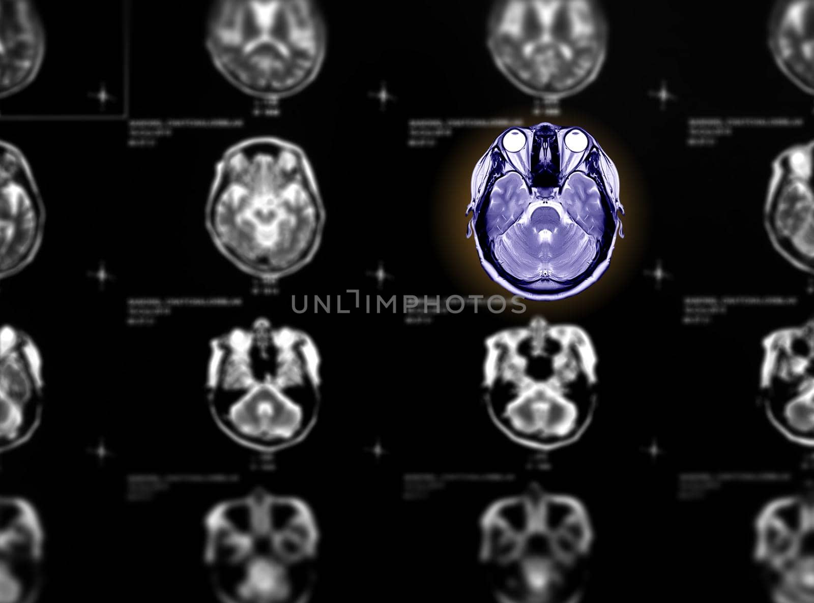 Selective focus of MRI brain axial view on blurred mri brain axial background.