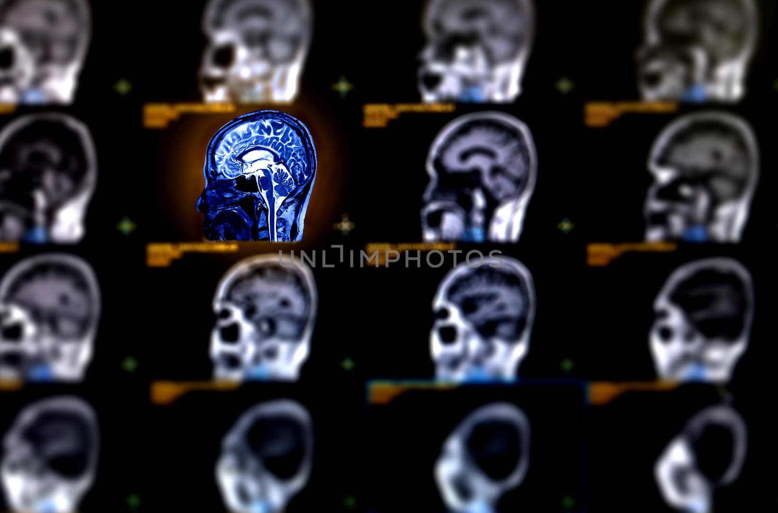 Selective focus of MRI brain axial view for detect a variety of conditions of the brain stroke disease. by samunella