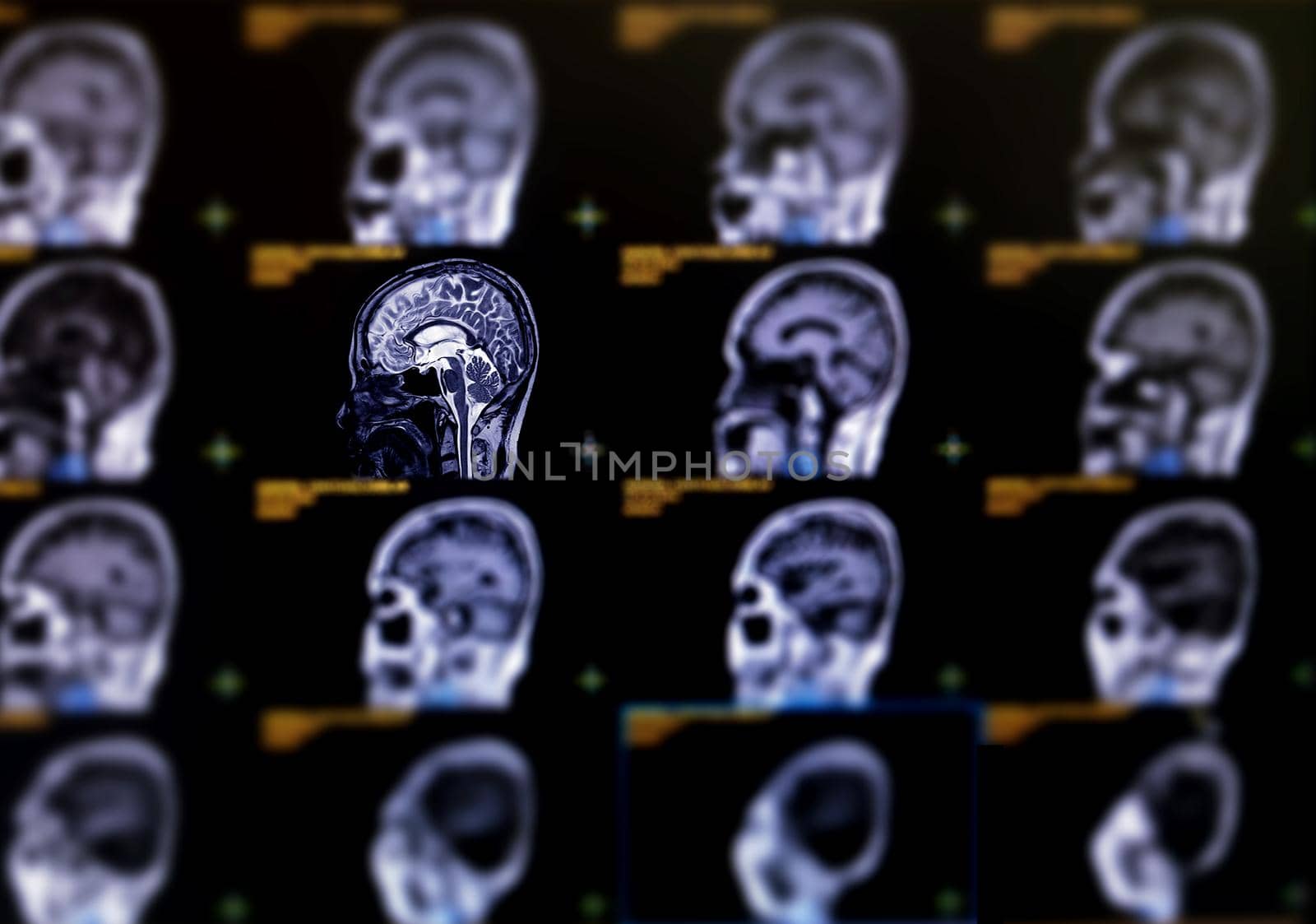 Selective focus of MRI brain sagittal plane for detect a variety of conditions of the brain such as cysts, tumors, bleeding, swelling, developmental and structural abnormalities or infections . by samunella