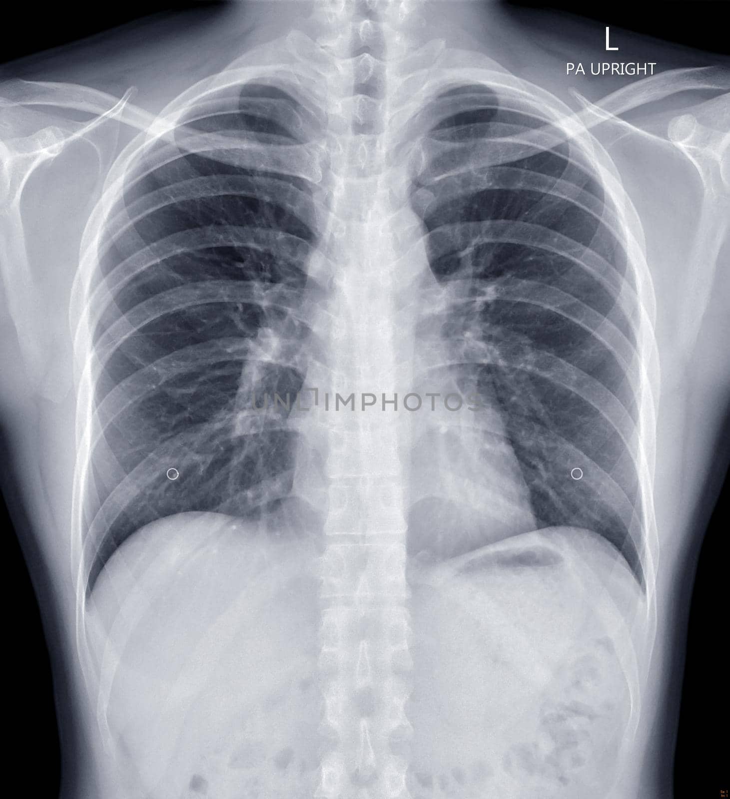 Chest X-ray or X-Ray Image Of human Chest by samunella