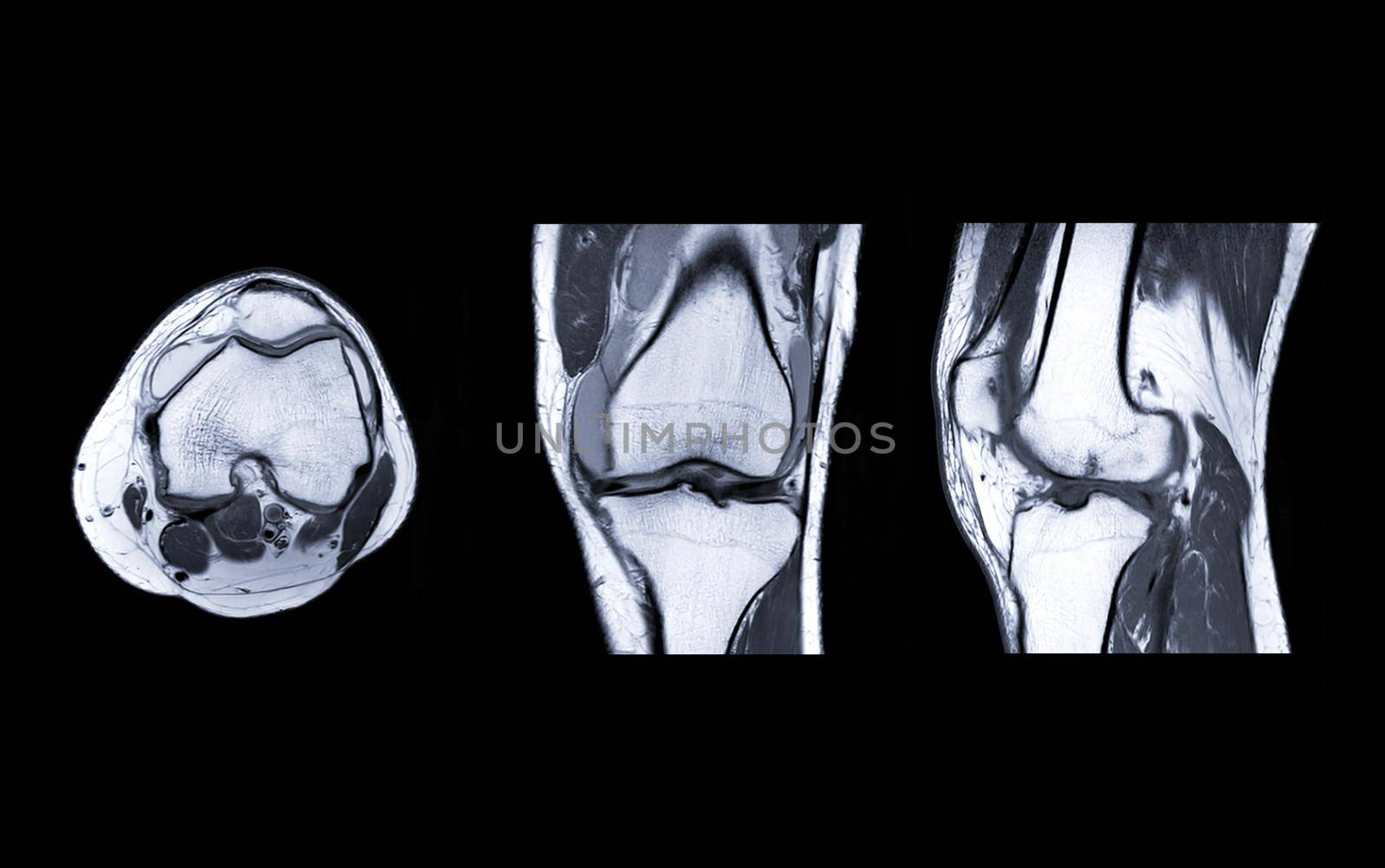 MRI Knee joint or Magnetic resonance imaging compare axial, coronal and sagittal view for detect tear or sprain of the anterior cruciate ligament (ACL).