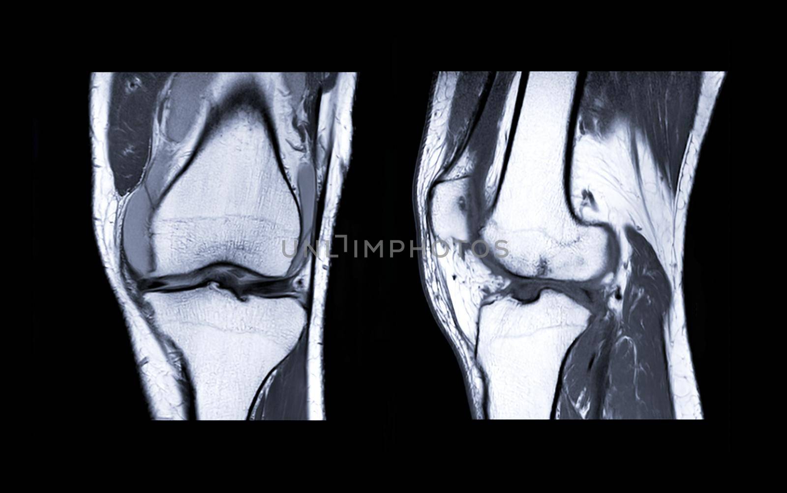 MRI Knee joint 3view by samunella