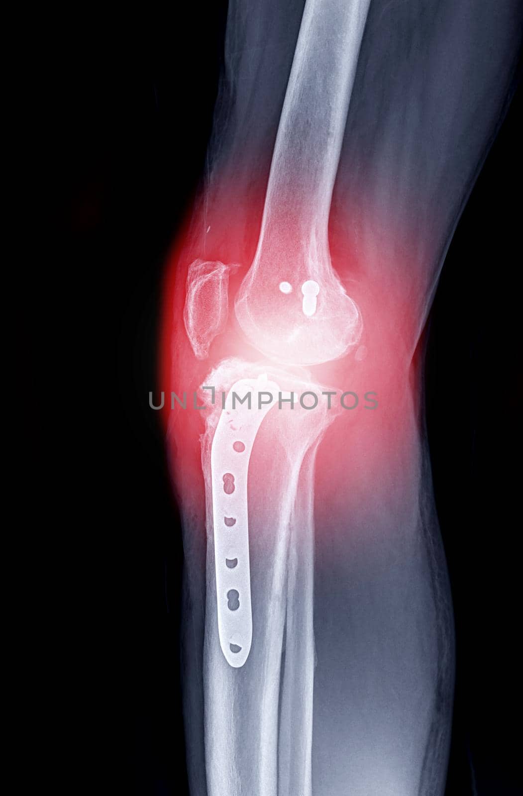 x-ray image of Right knee AP view. by samunella
