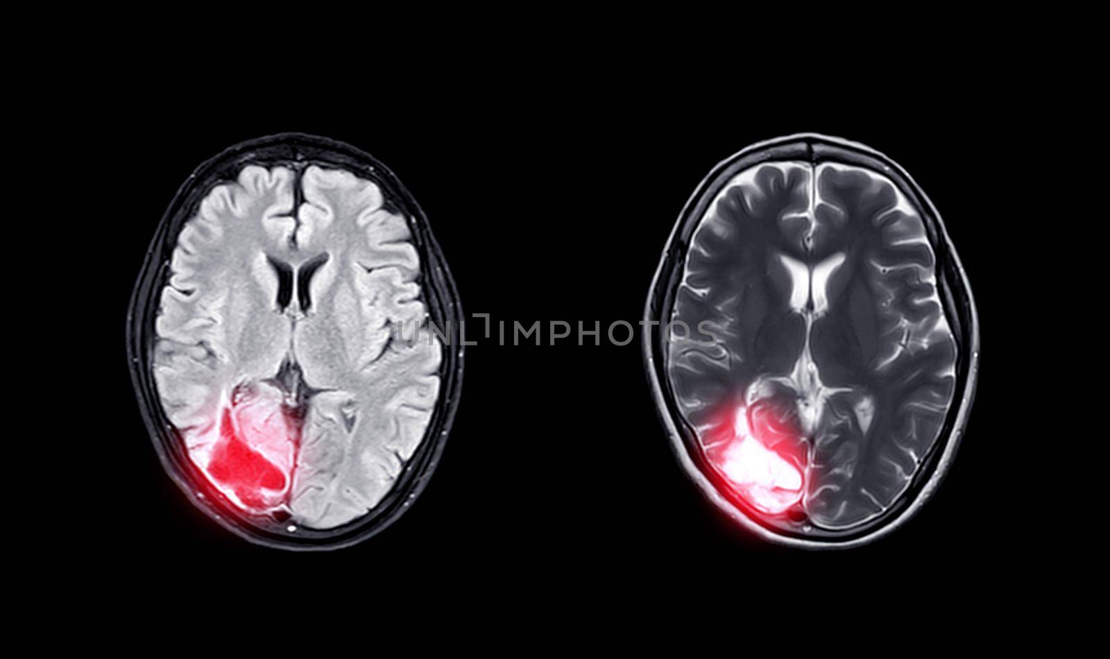Compare MRI brain Axial T2W flair and T2W view for showing enchepalomalacia disease.