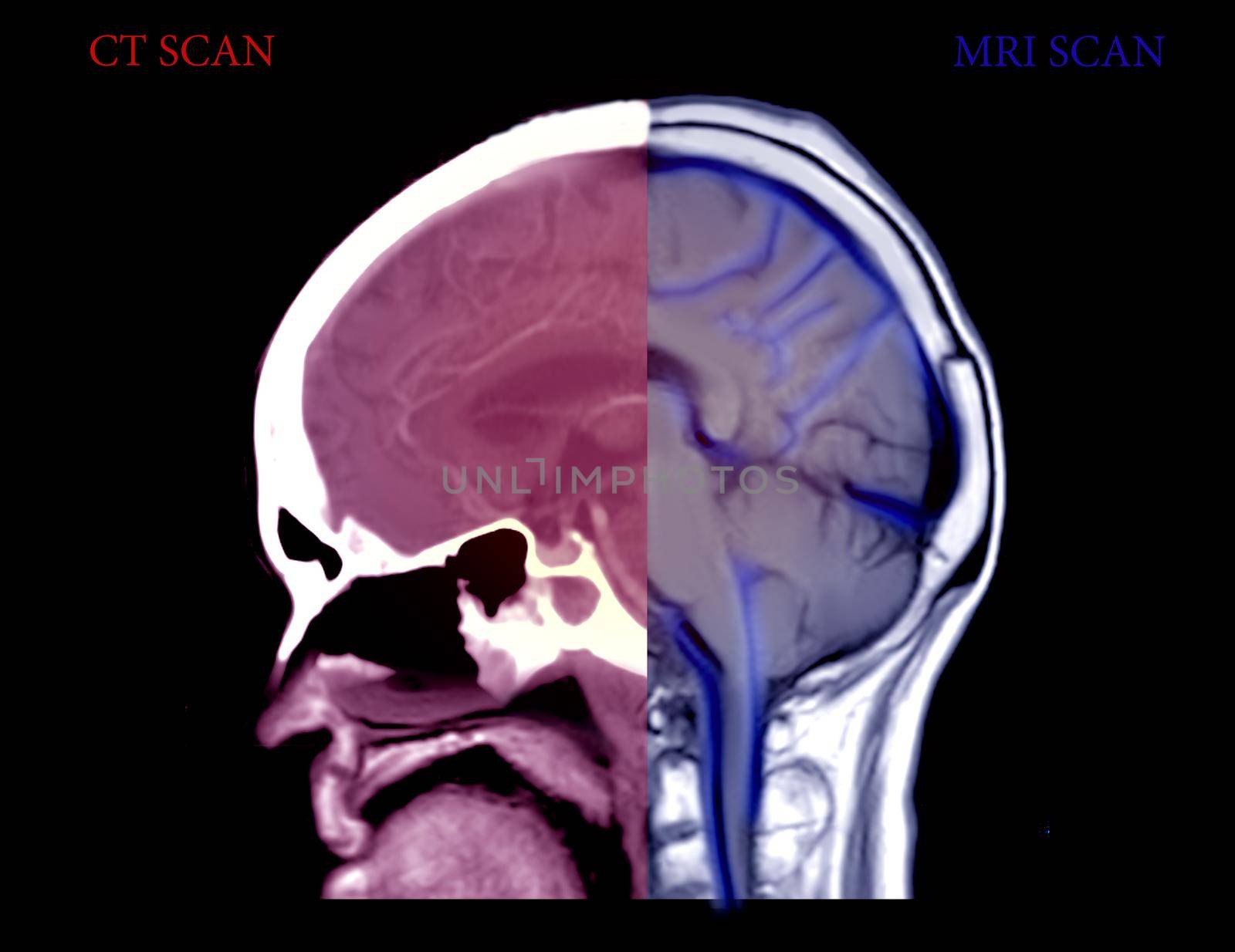 Compare CT Brain and MRI Brain sagittal view . Medical background concept.