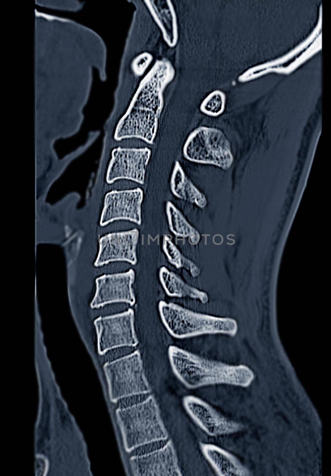 CT C-Spine or Cervical spine sagittal view in patient trauma cervical spine injury.