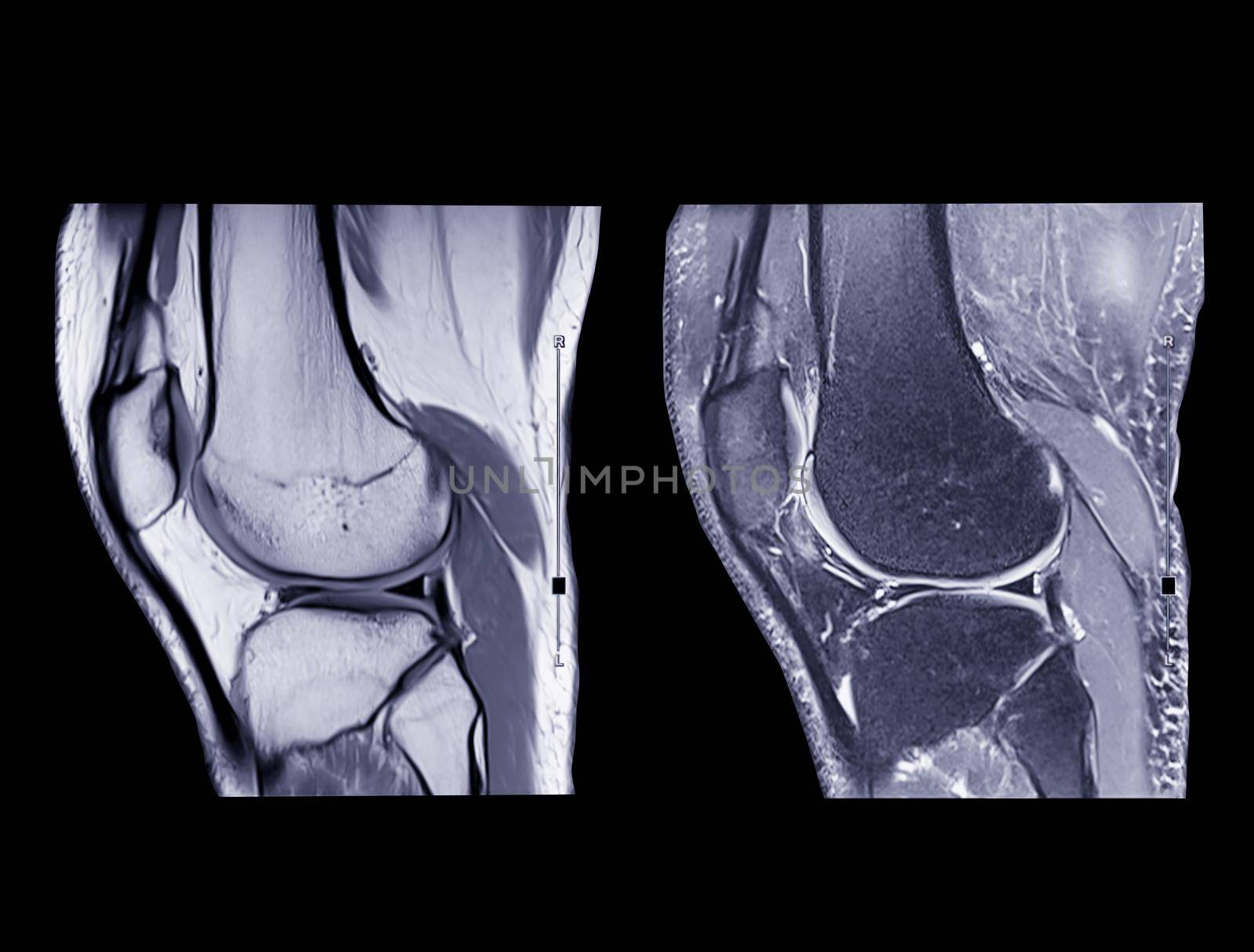 Magnetic resonance imaging or MRI knee comparison sagittal PDW and TIW view. by samunella