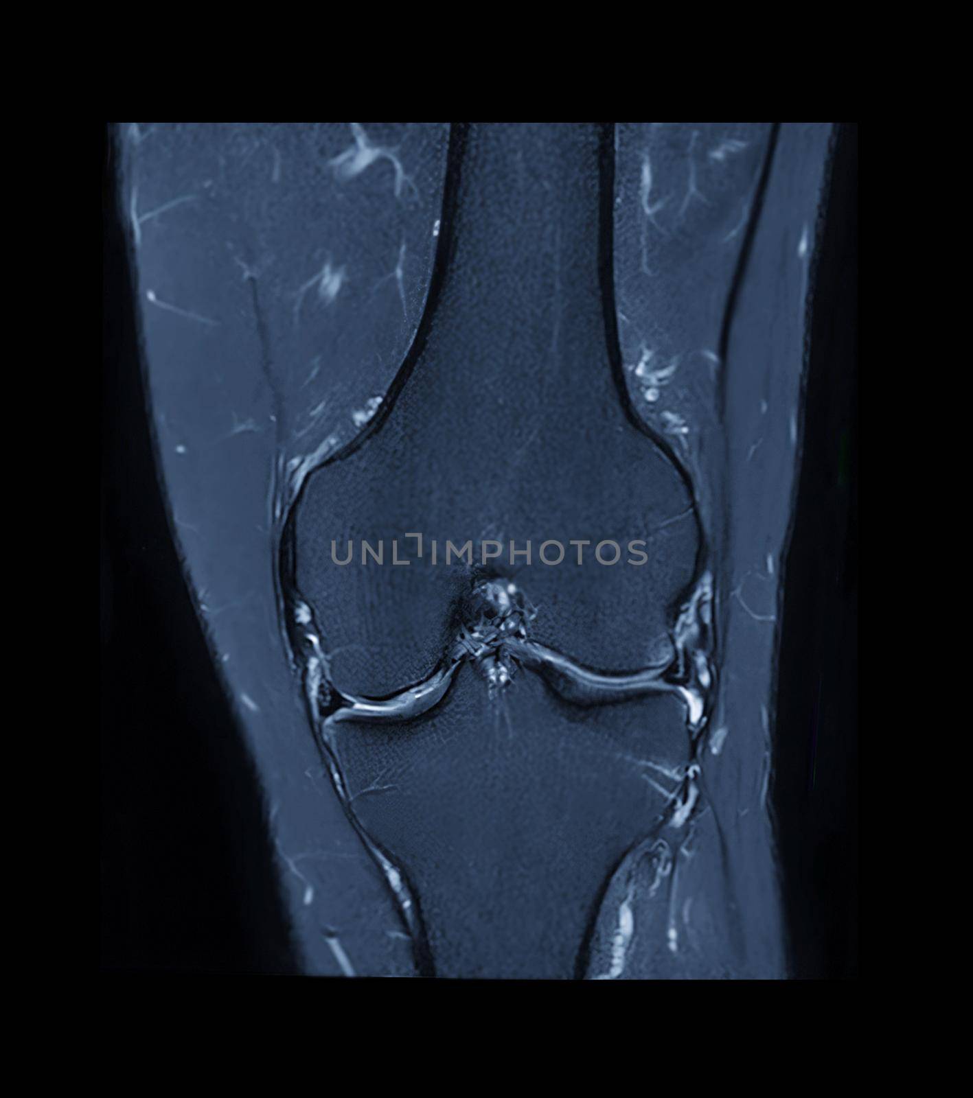 MRI knee or Magnetic resonance imaging of knee joint stir technique of coronal view for fat suppression.