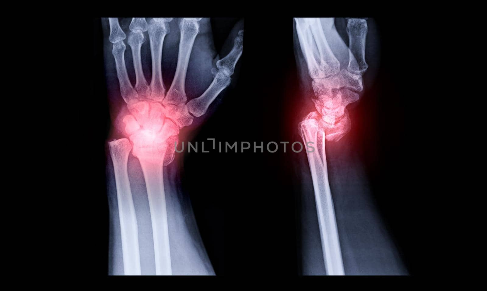 X-ray image of Left wrist joint AP and Lateral view for showing fracture of radius bone.