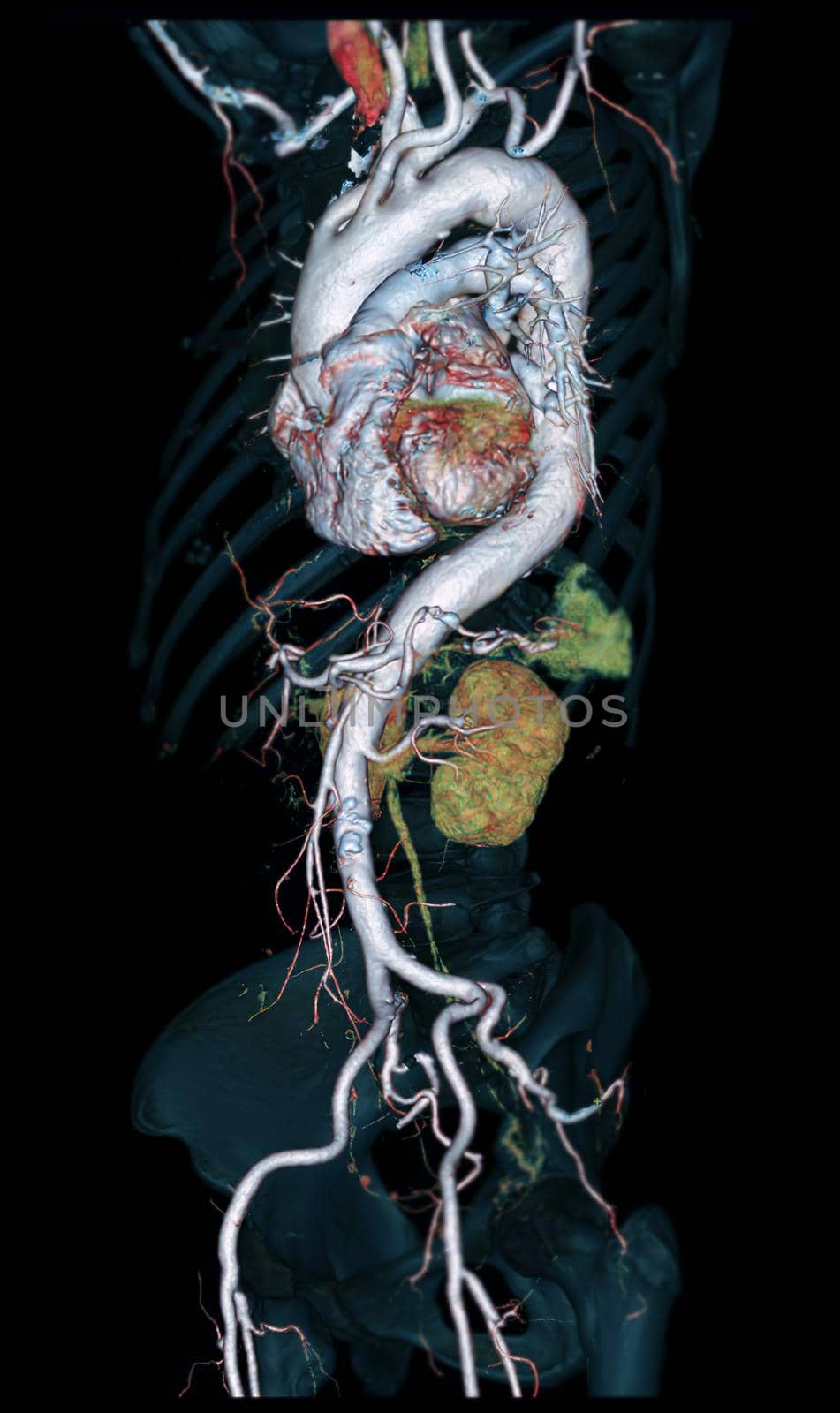 CTA Whole aorta 3D rendering image on black background for detect aortic aneurysm. by samunella