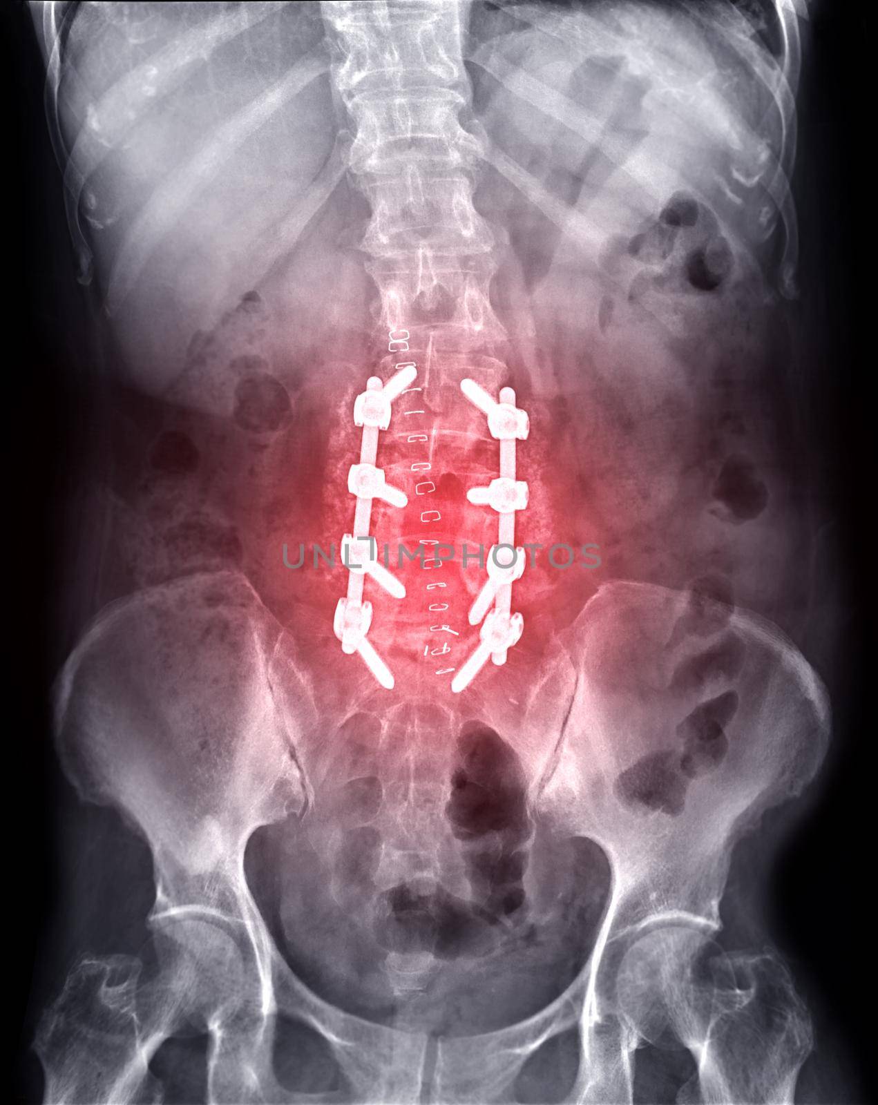 X-ray image of lambosacral spine or L-S spine AP Post operative Fix Lumbar Plates and screw.