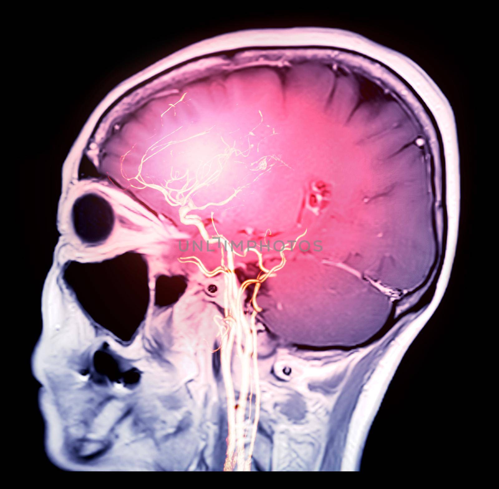 MRI brain T1 sagittal plane with 3D rendering CTA Brain .