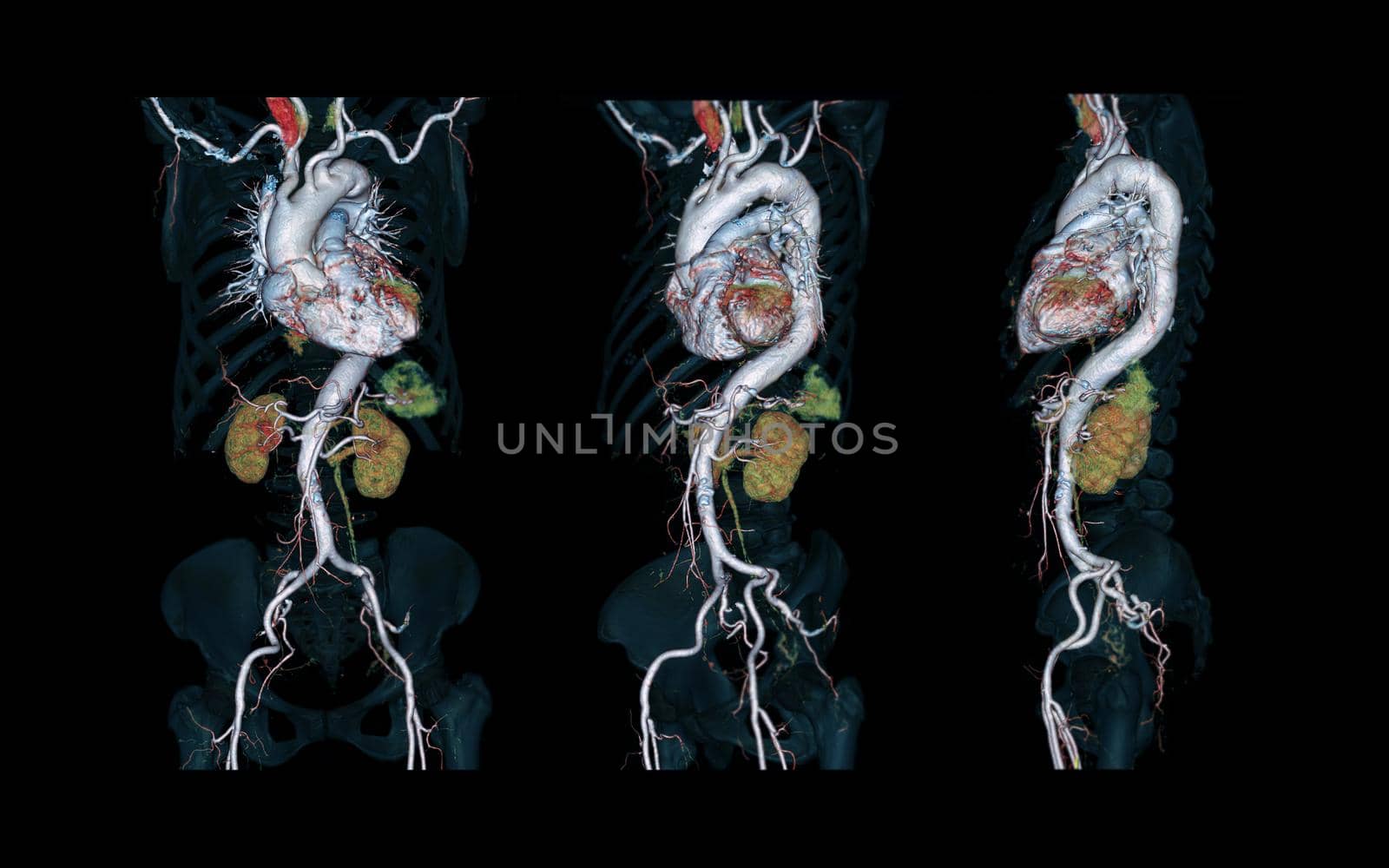 CTA Whole aorta 3D rendering image on black background for detect aortic aneurysm.