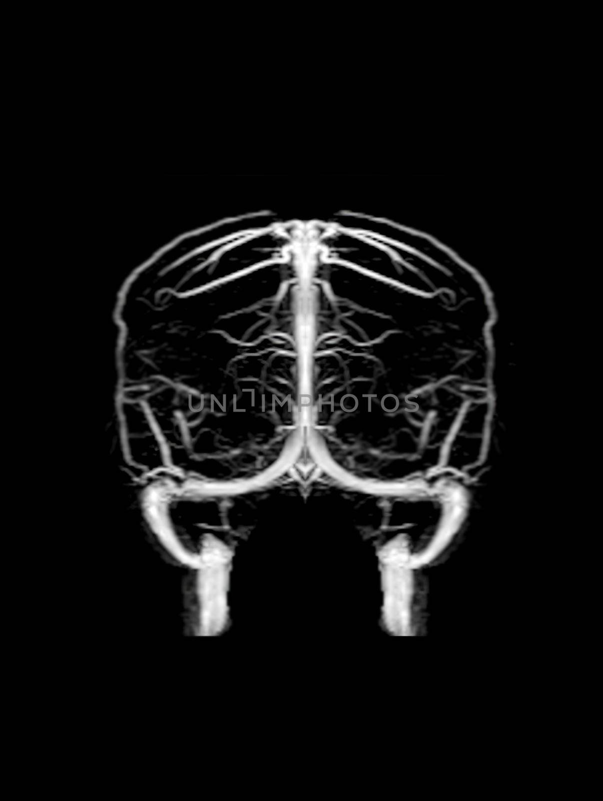 MRV Brain or magnetic resonance venography of The Brain for abnormalities in venous drainage of the brain