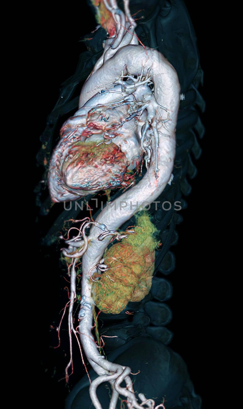CTA Whole aorta 3D rendering image lateral view on black background for detect aortic aneurysm.