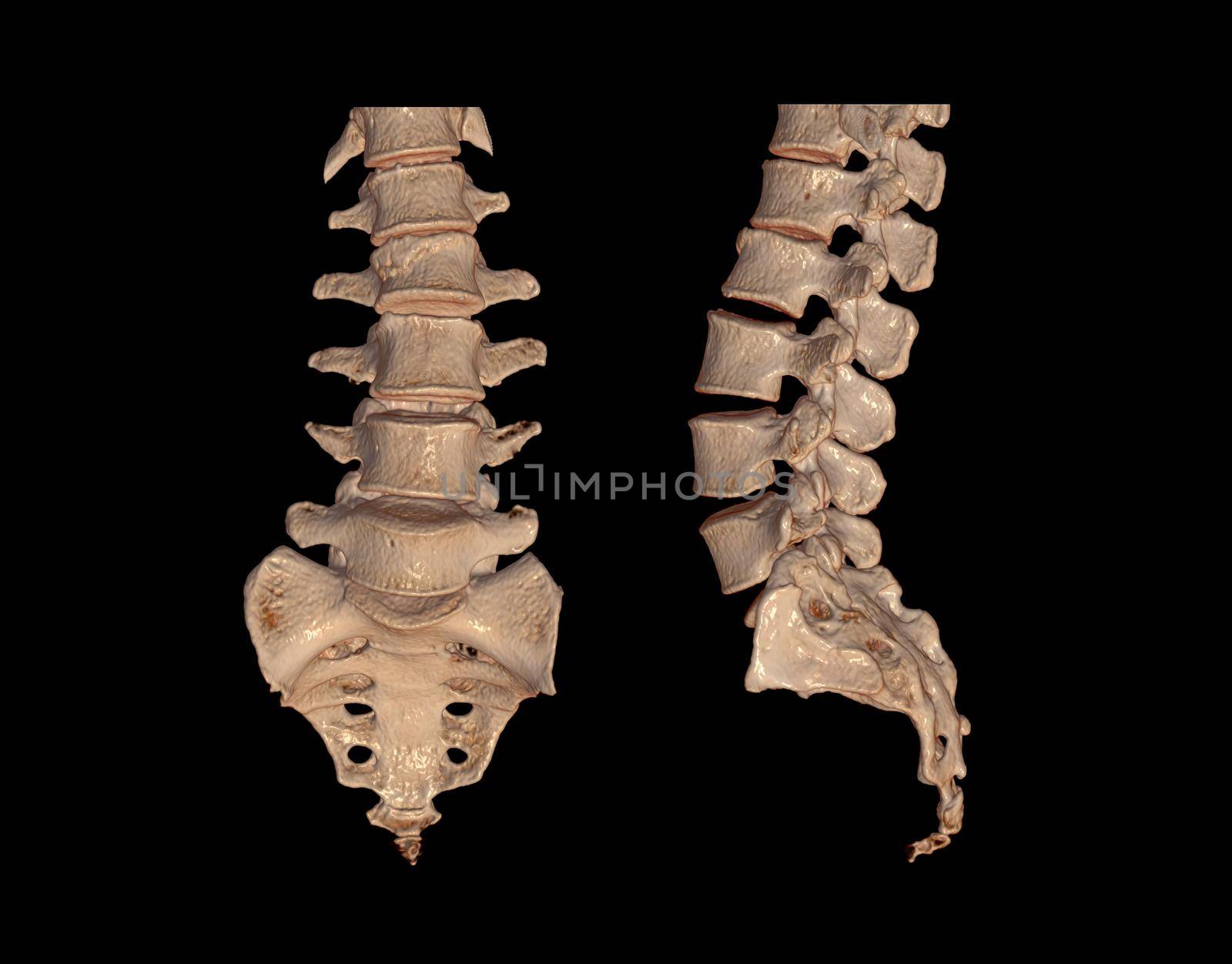 Collection of CT Lumbar or L-S spine 3D rendering image AP and Lateral view showing Compression fractures at L2. 3D illustration.