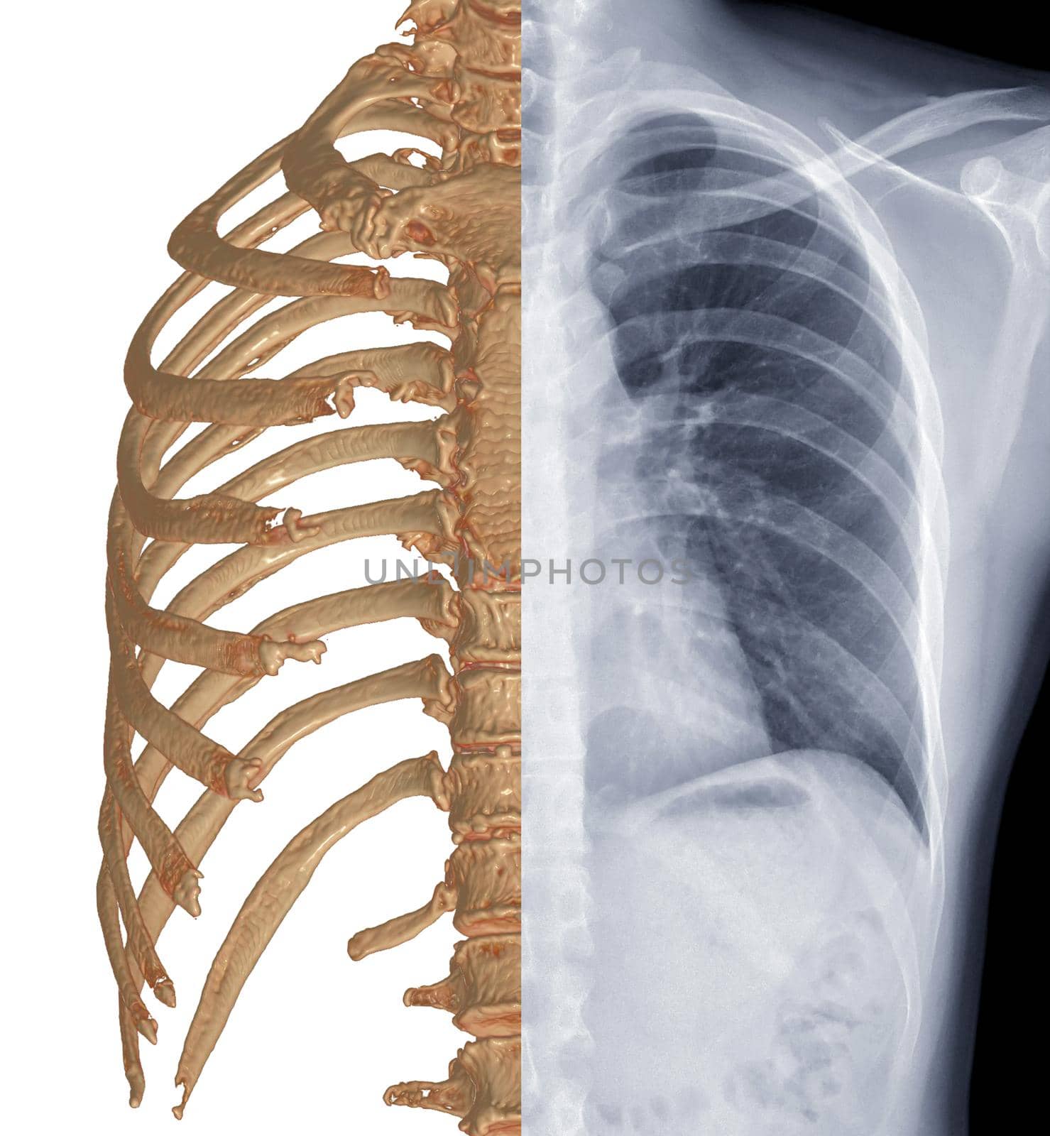 Compare CT Chest 3D rendering and Chest x-ray . by samunella