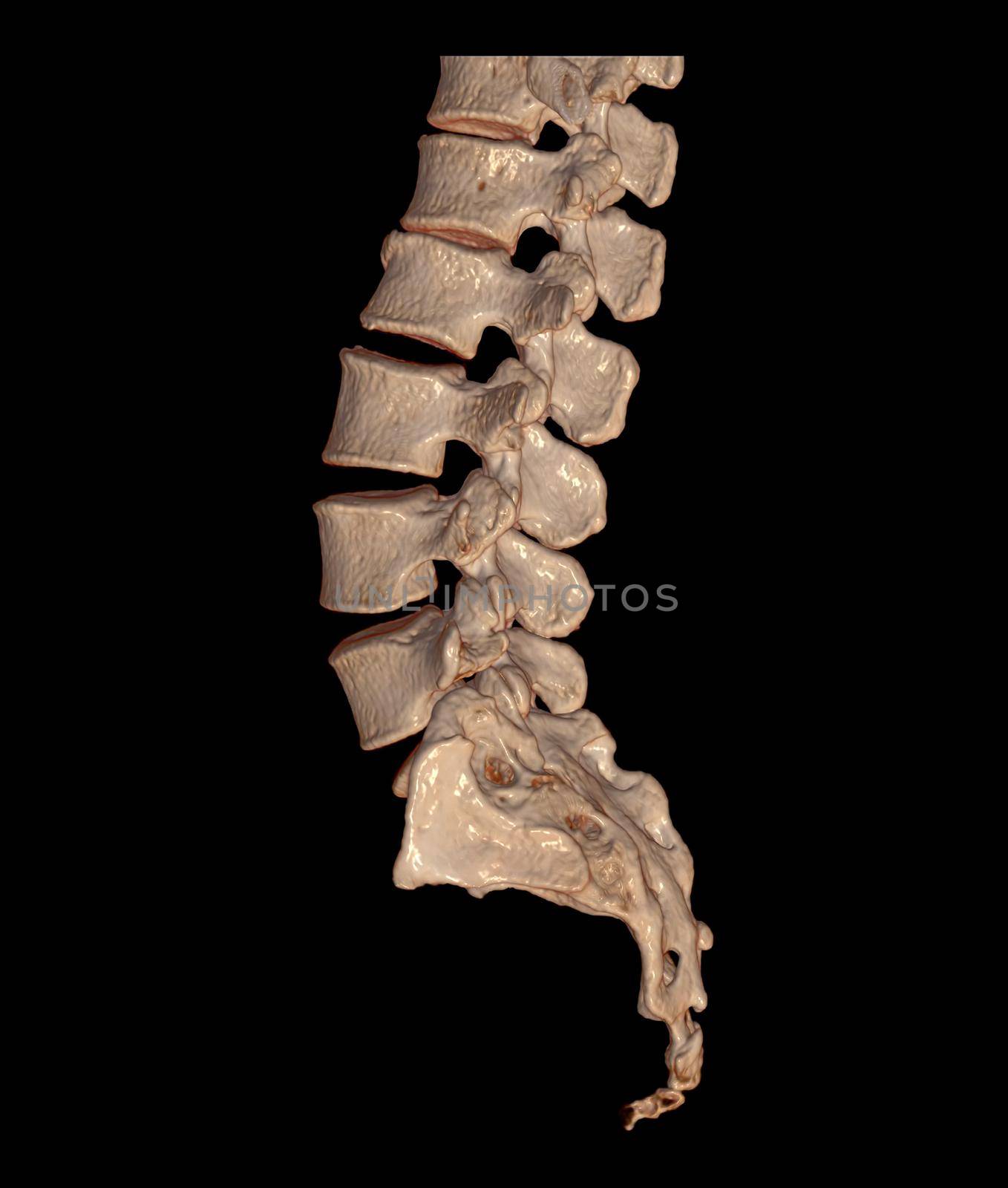 CT Lumbar or L-S spine 3D rendering image Lateral view showing Compression fractures at L2. 3D illustration.