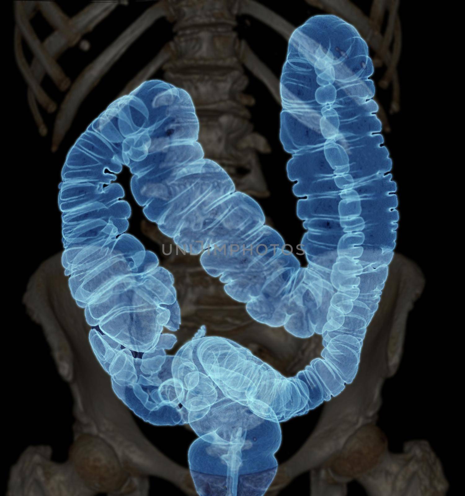 CT colonography or CT Scan of Colon 3D Rendering image AP view showing colon for screening colorectal cancer. Check up Screening Colon Cancer.