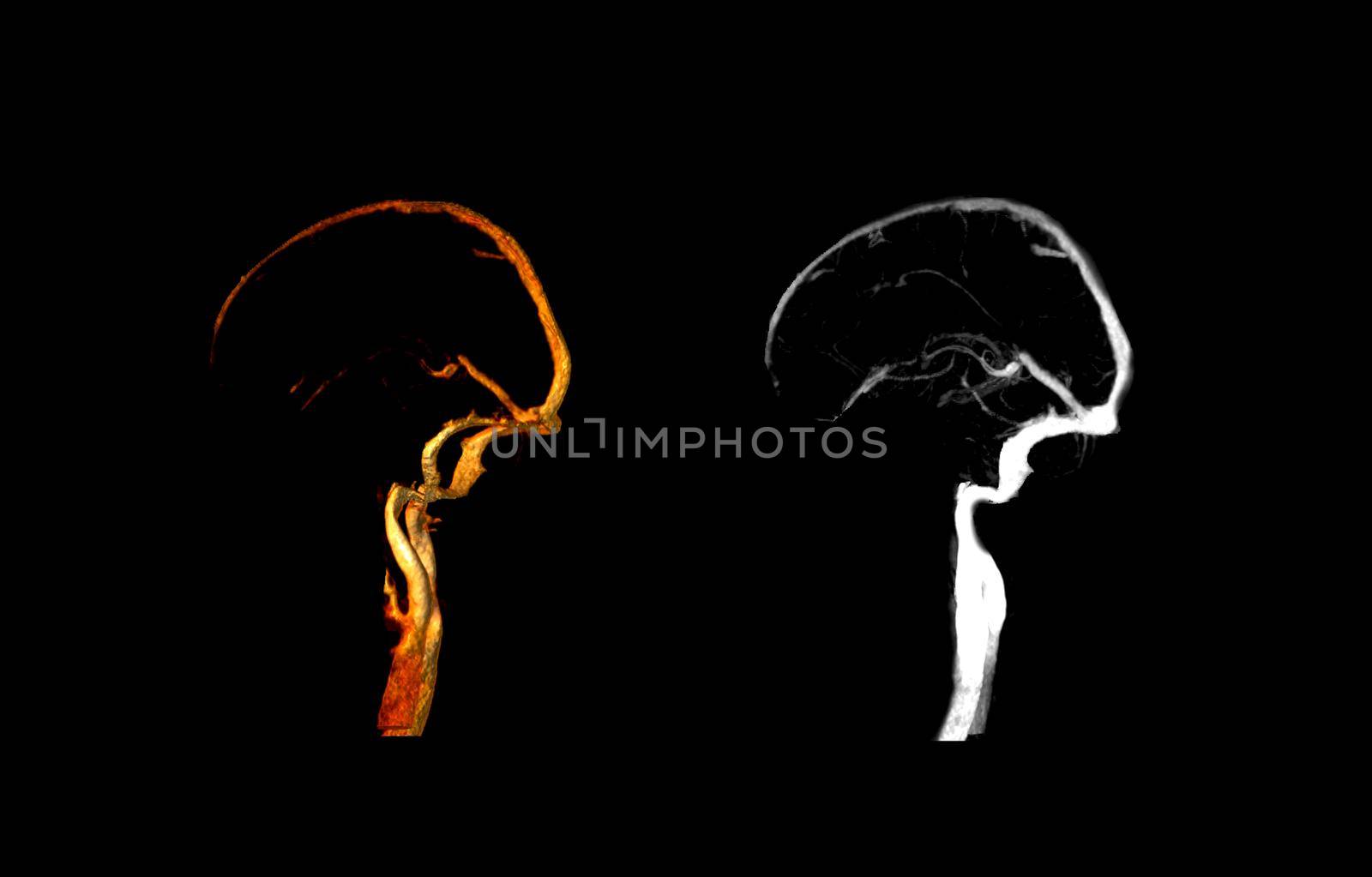 CTV BRAIN Lateral view compare 3D and MIP image.