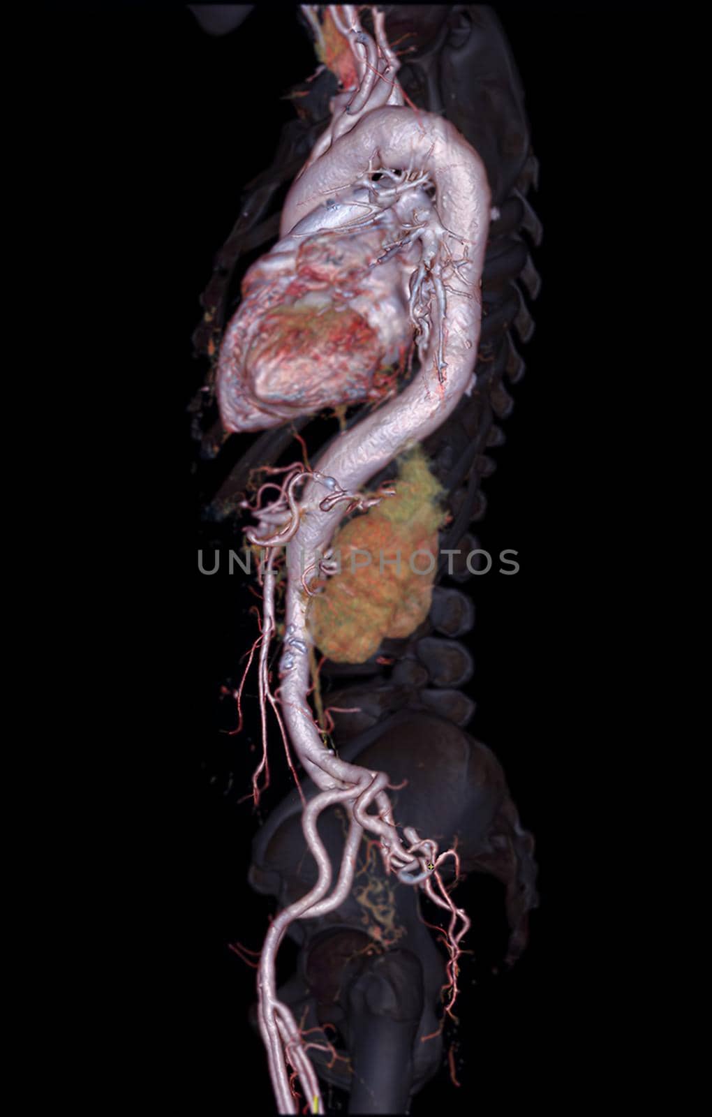 CTA abdominal aorta 3D rendering image on transparent skeletal . by samunella