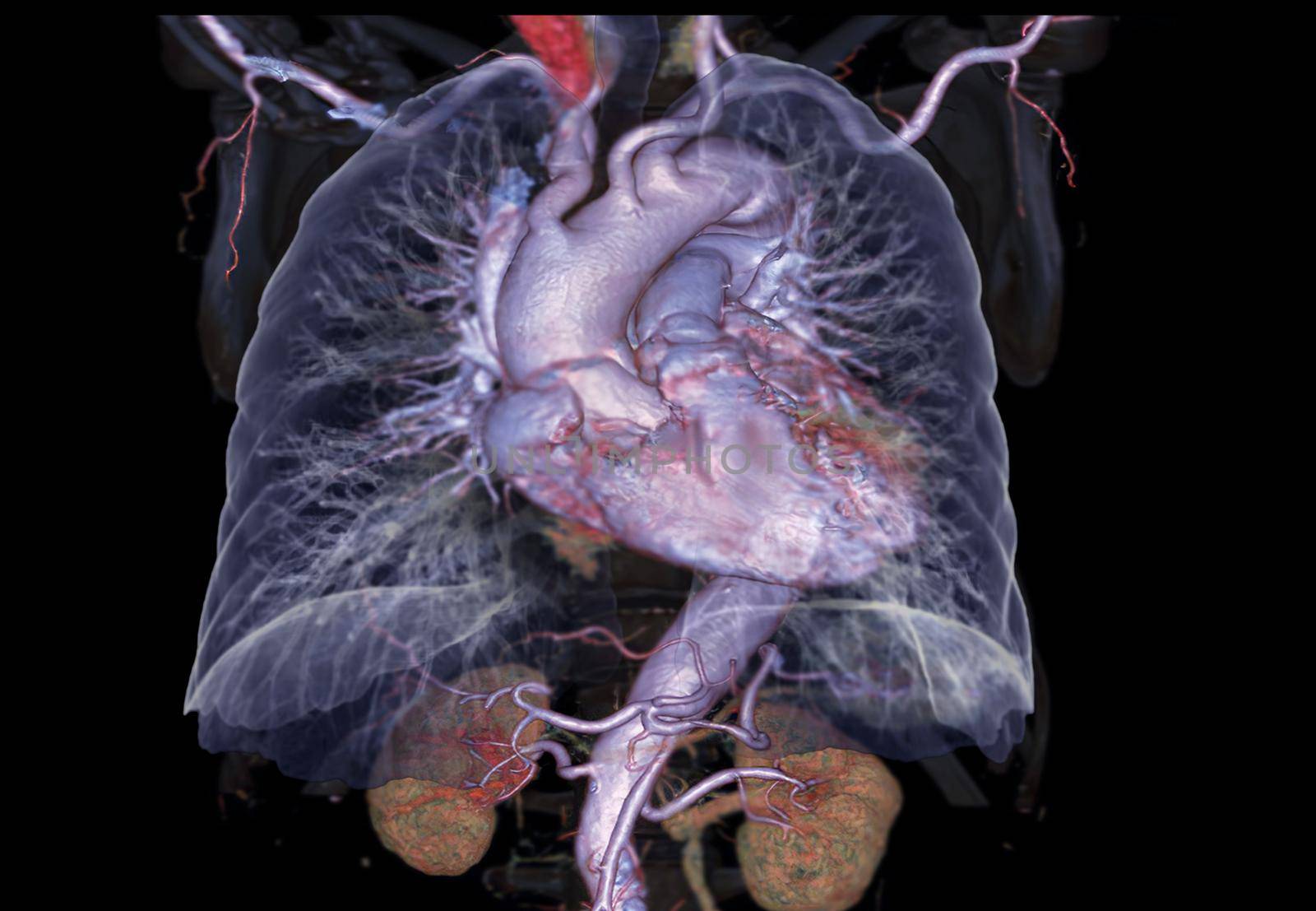 CTA Chest with Lung 3D rendering image showing heart ,lung amd bone tramsparent.