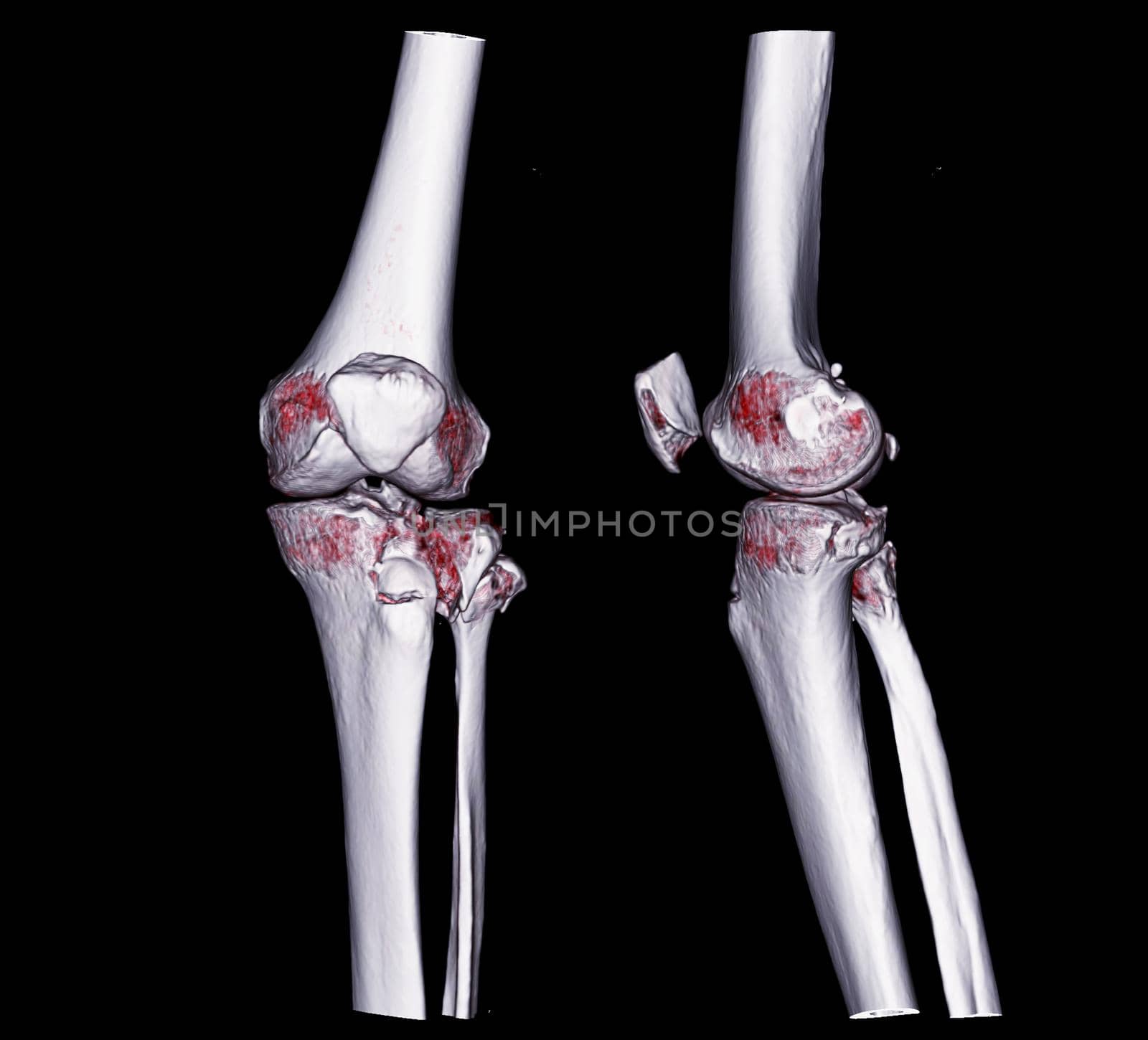 CT knee 3D rendering image AP and Lateral view isolated on black background showing fracture tibia.