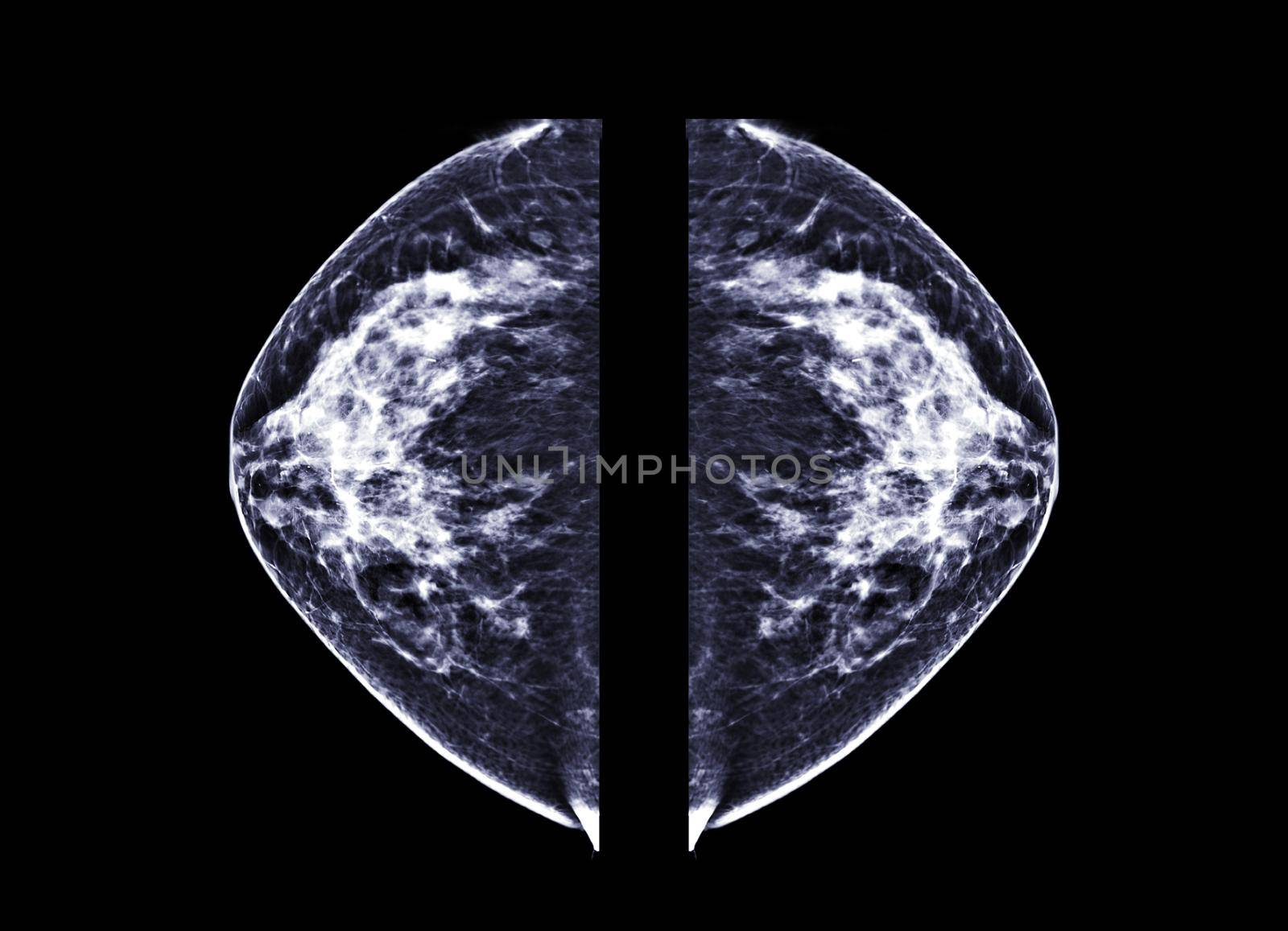 X-ray Digital Mammogram or mammography both side of the breast CC view for finding Breast cancer in women . by samunella