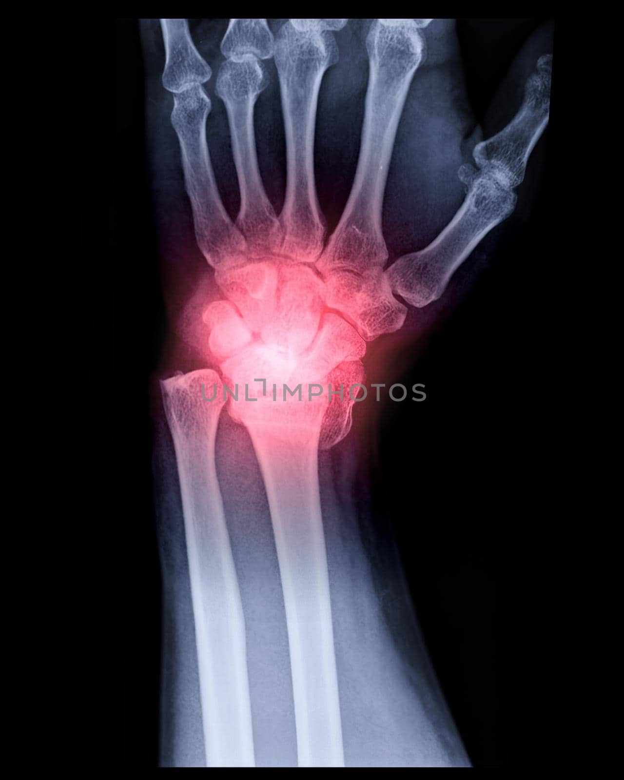 X-ray image of Left wrist joint AP view for showing fracture of radius bone.