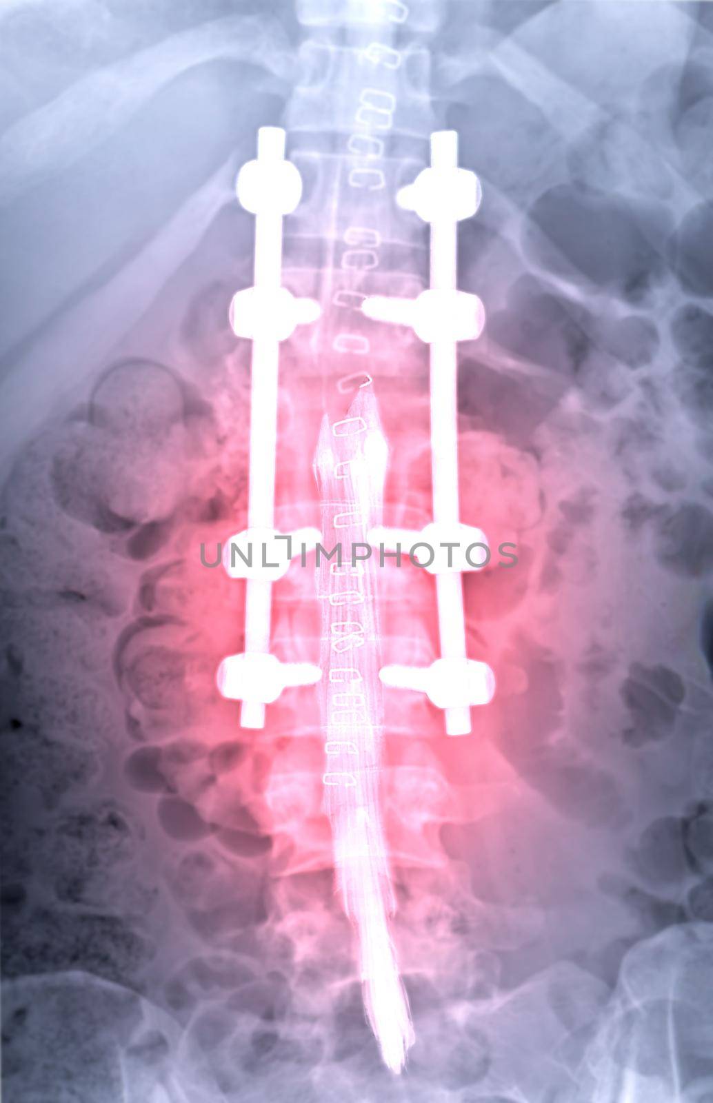 myelography is particularly sensitive at detecting small disk herniations compressing nerves of the spine .