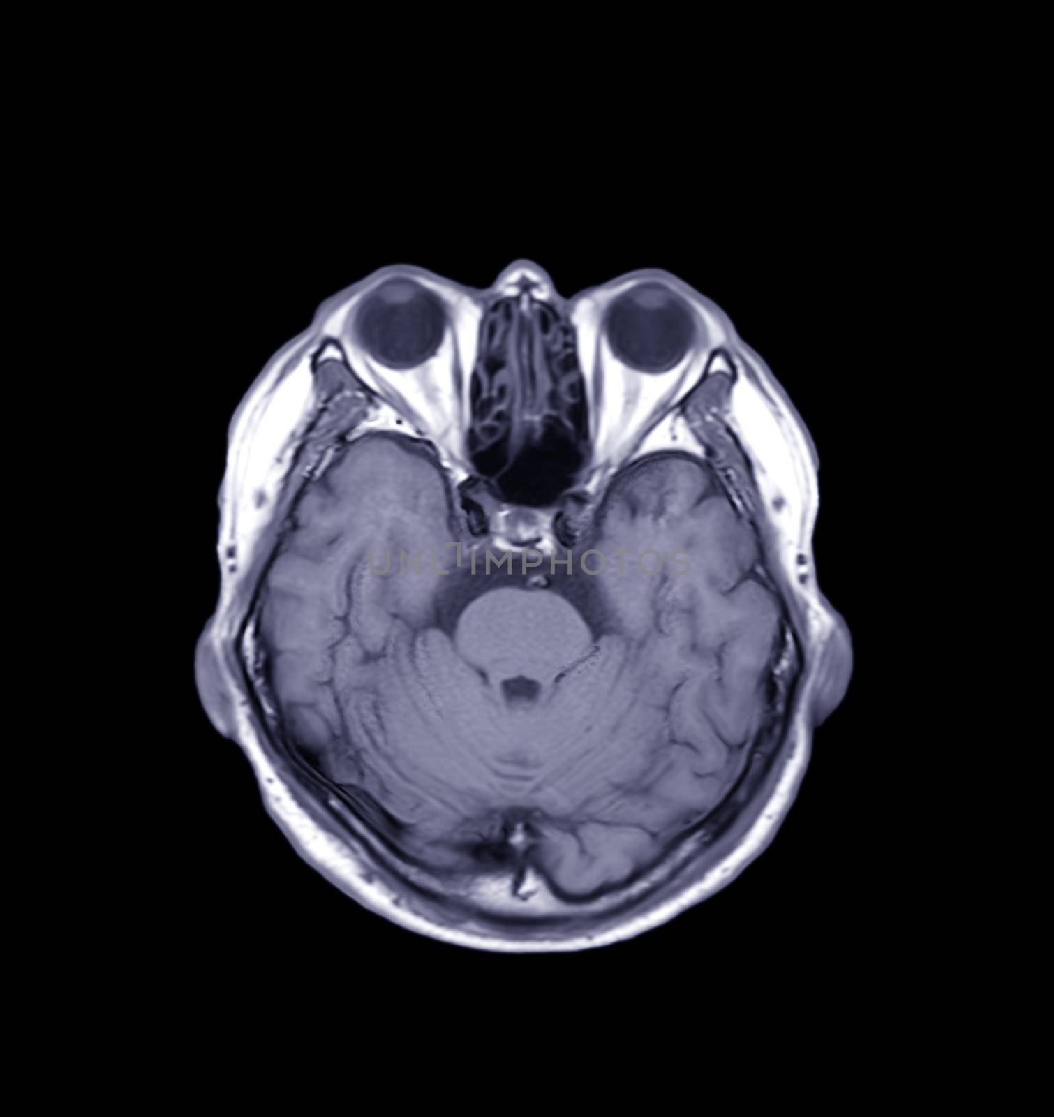 MRI of the brain Axial T1 view by samunella