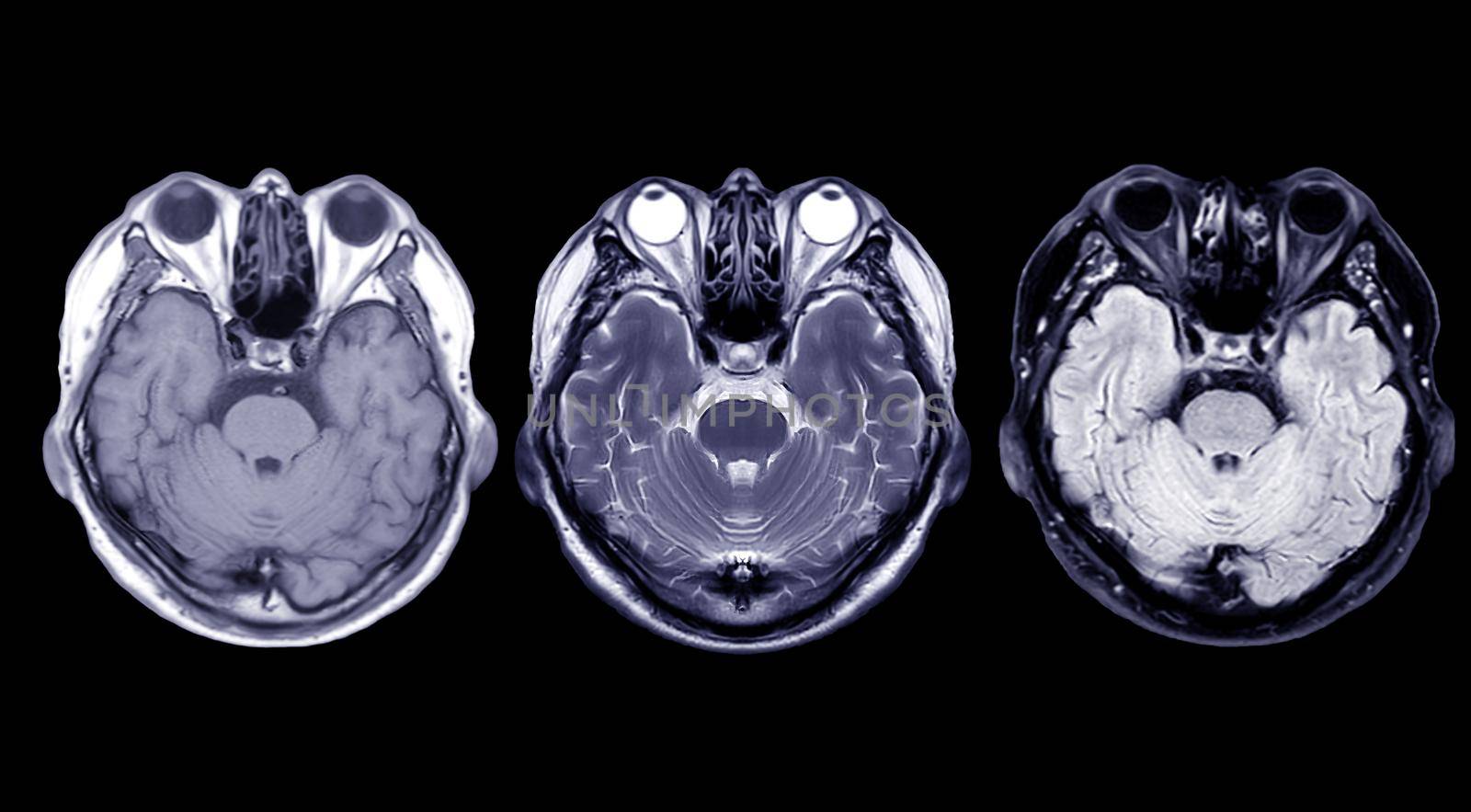 Compare MRI of the brain Axial T1, T2 and T2 Flair by samunella