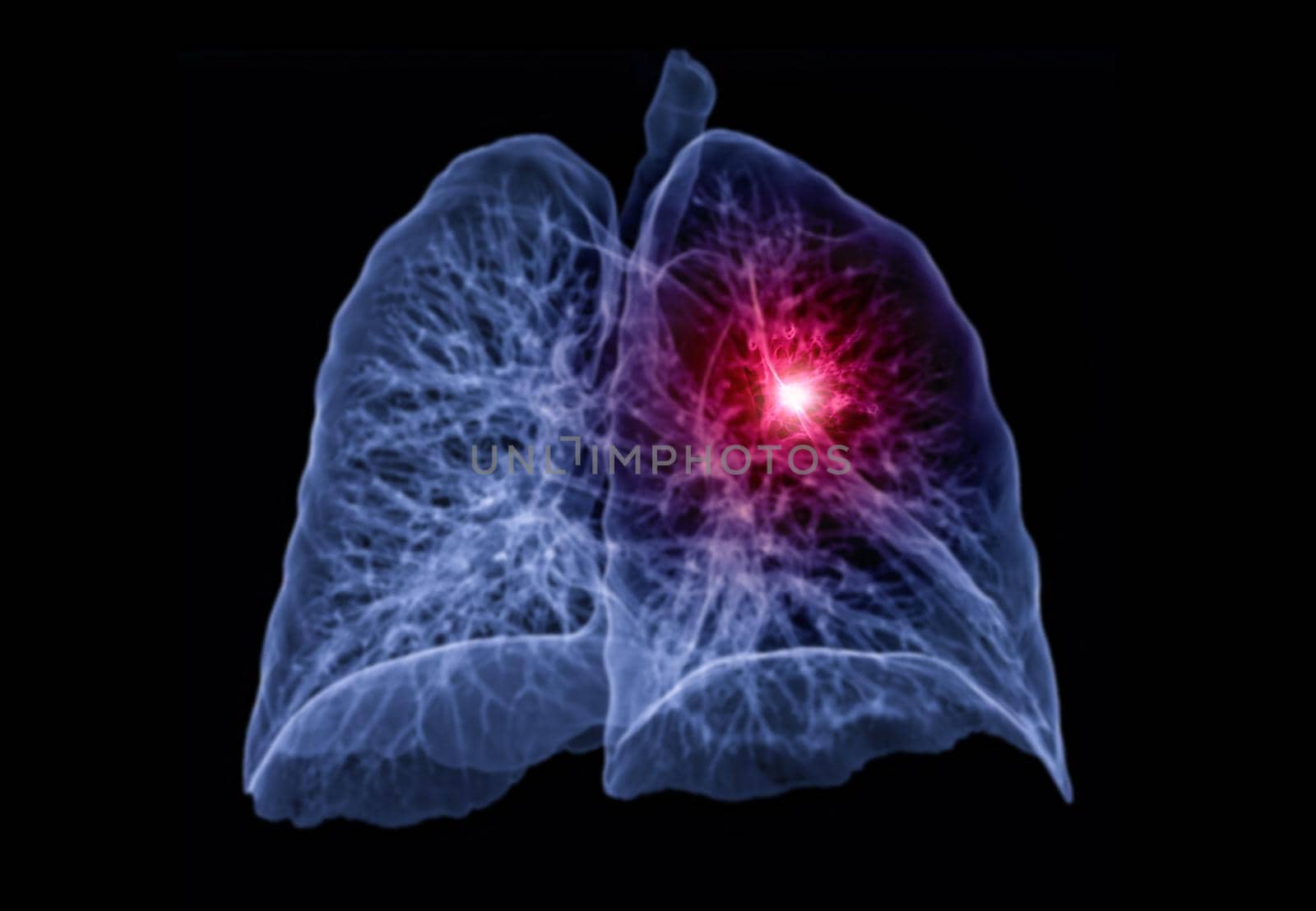 CT lung 3d rendering imag by samunella