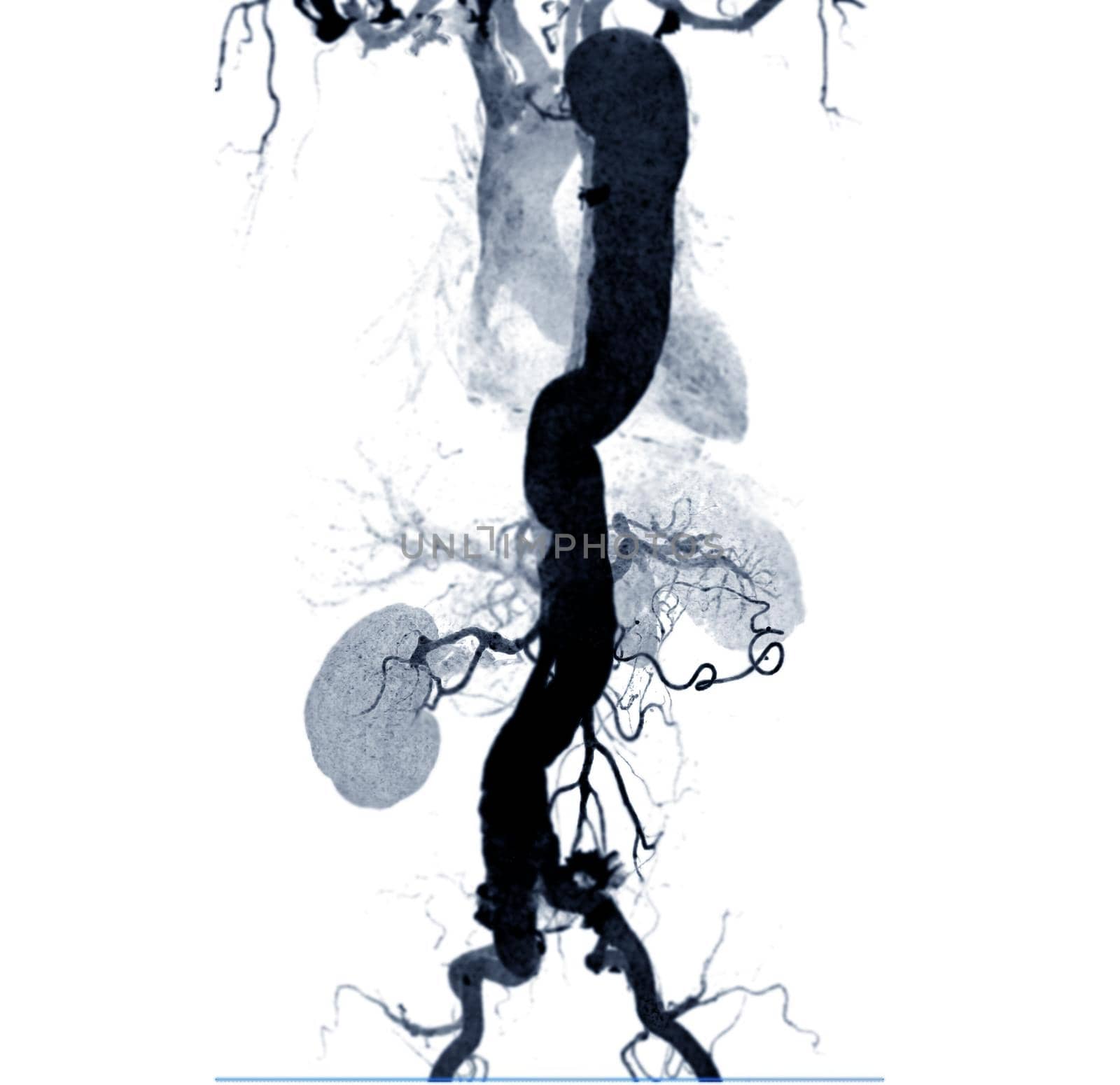 CTA abdominal aorta 3D MIP image on white background.