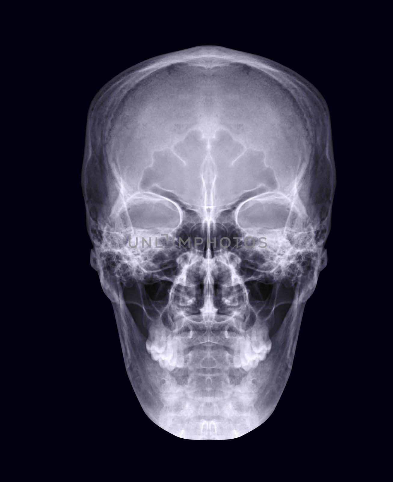 Skull x-ray image of Human skull AP or front view isolated on Black Background. clipping path. by samunella