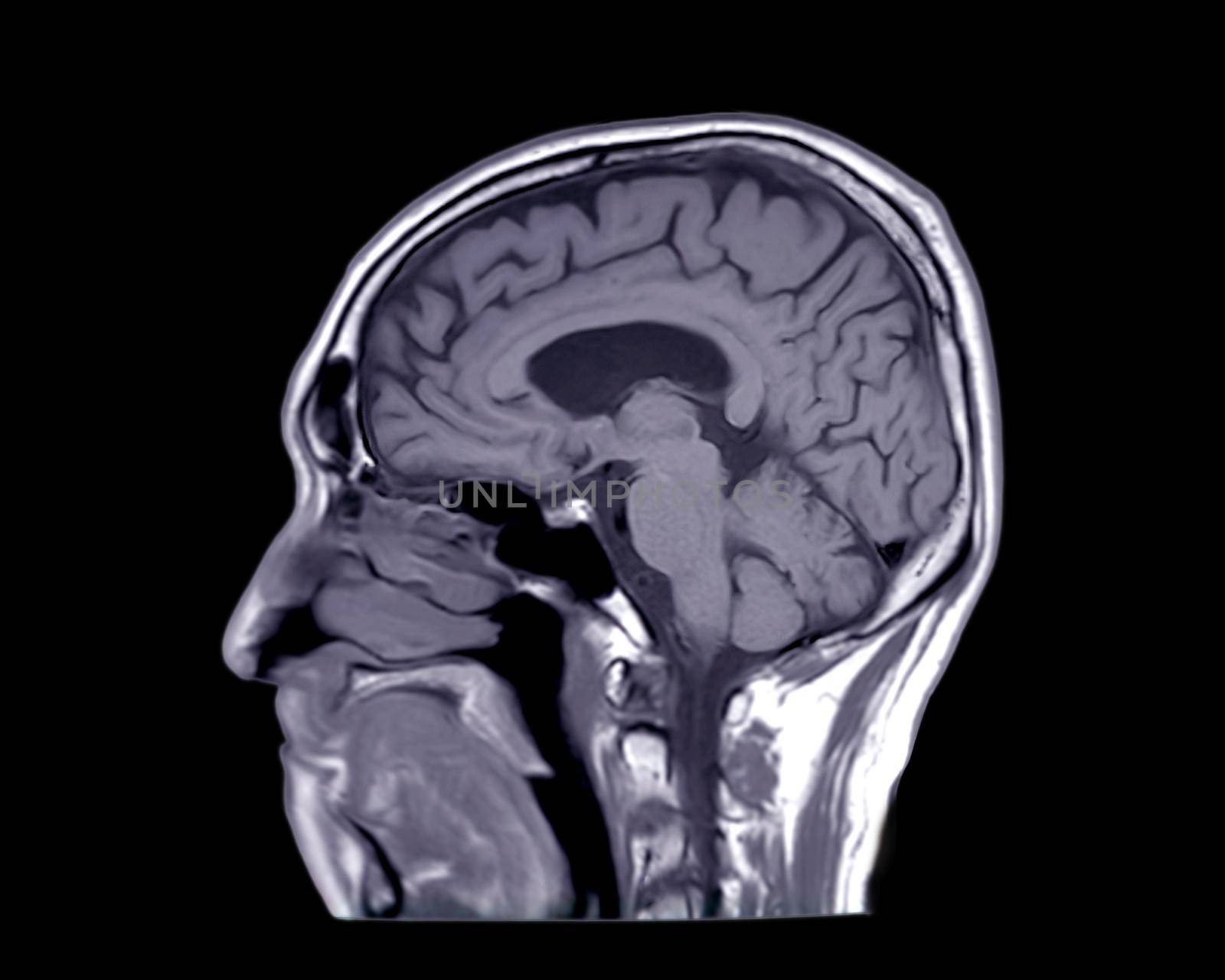 MRI of the brain sagittal T1 view for detect a variety of conditions of the brain such as cysts, tumors, bleeding isolated on black backgroud , bleeding . Clipping path.