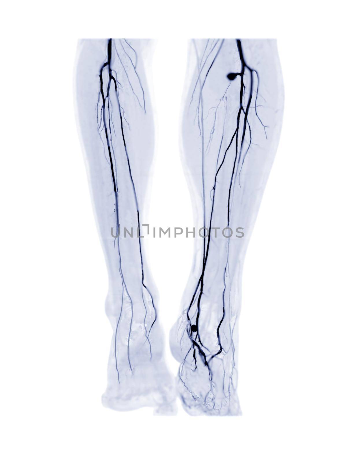 CTA femoral artery run off 3D MIP image or CTA leg for diagnosis Acute or Chronic Peripheral Arterial Disease in Diabetic patient.