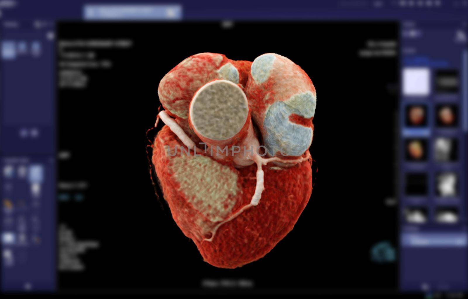 CTA Coronary artery 3D rendering image for finding coronary artery disease on blurred screen background.