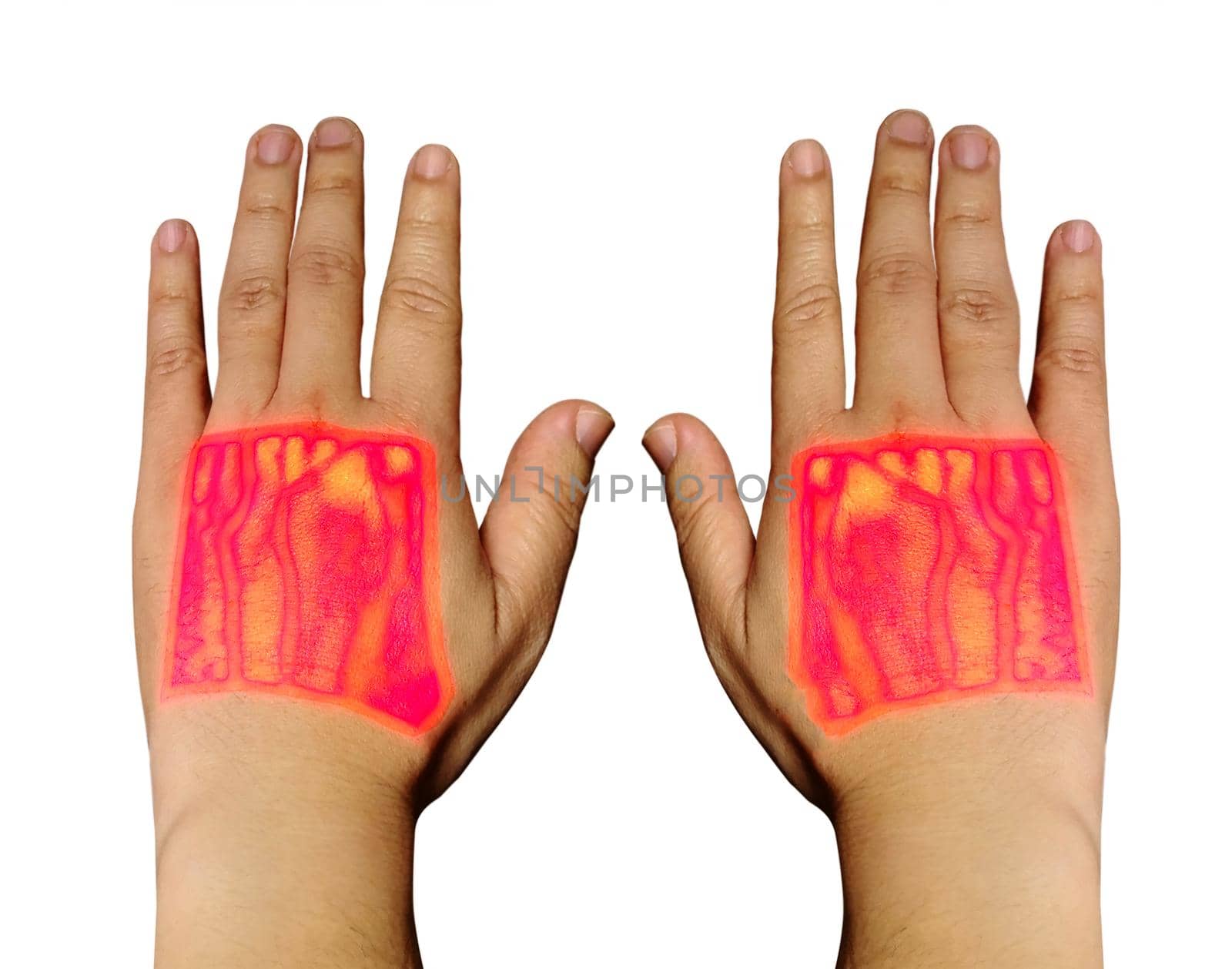 Vein finder handheld infrared of Both hand showing cephalic vein and basilic vein for blood sample test