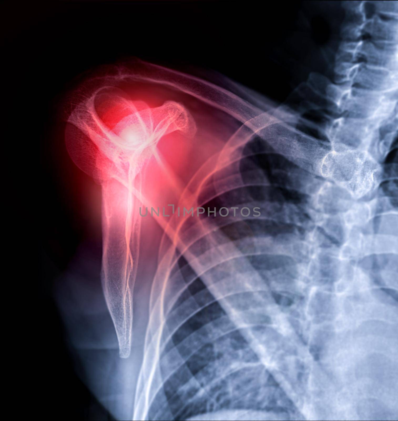 X-ray Shoulder joint transcapular view for diagnosis fracture of shoulder joint.