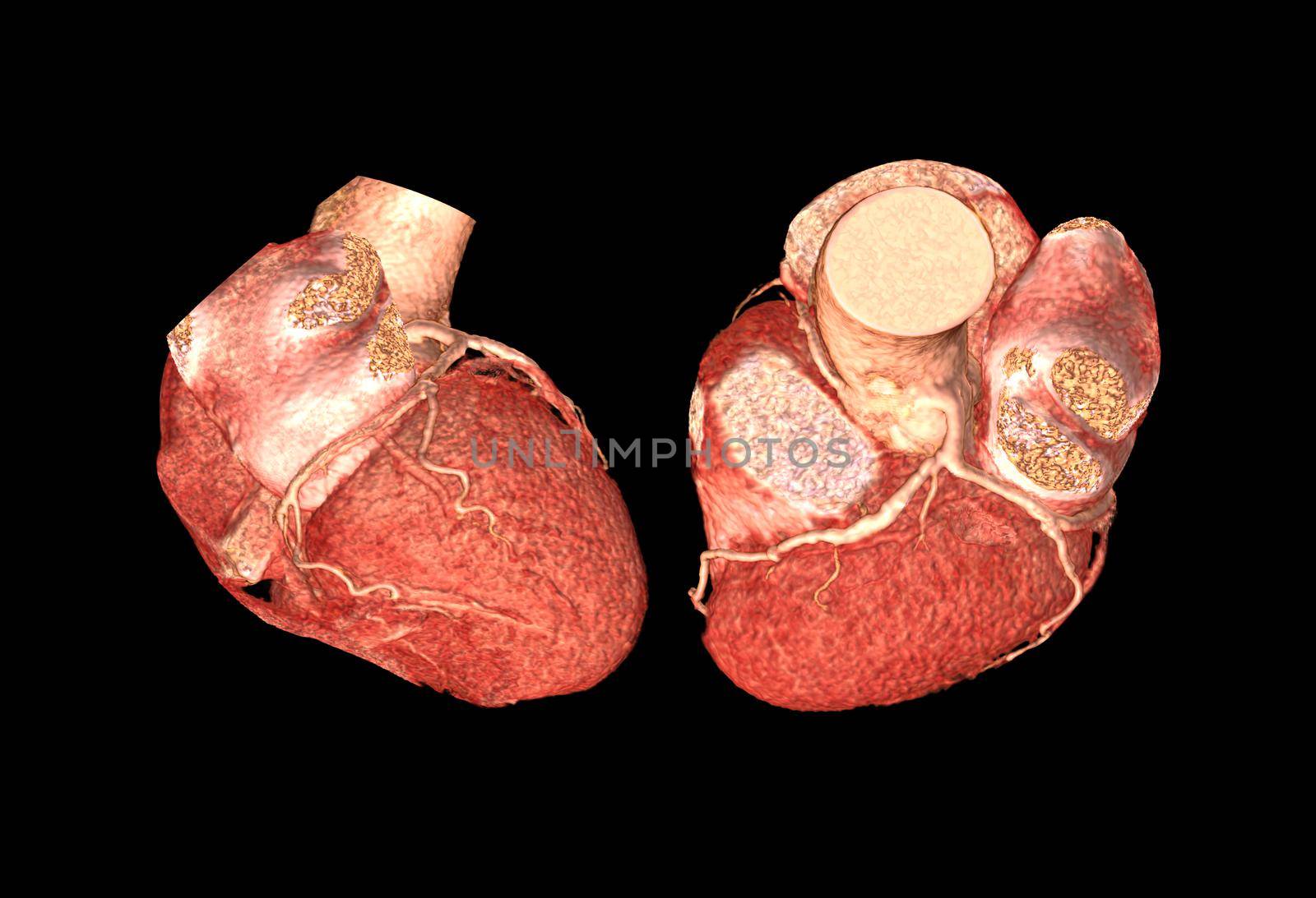 Lateral ad Top view of CTA Coronary artery 3D rendering image isolated o black backgroud for finding coronary artery disease.