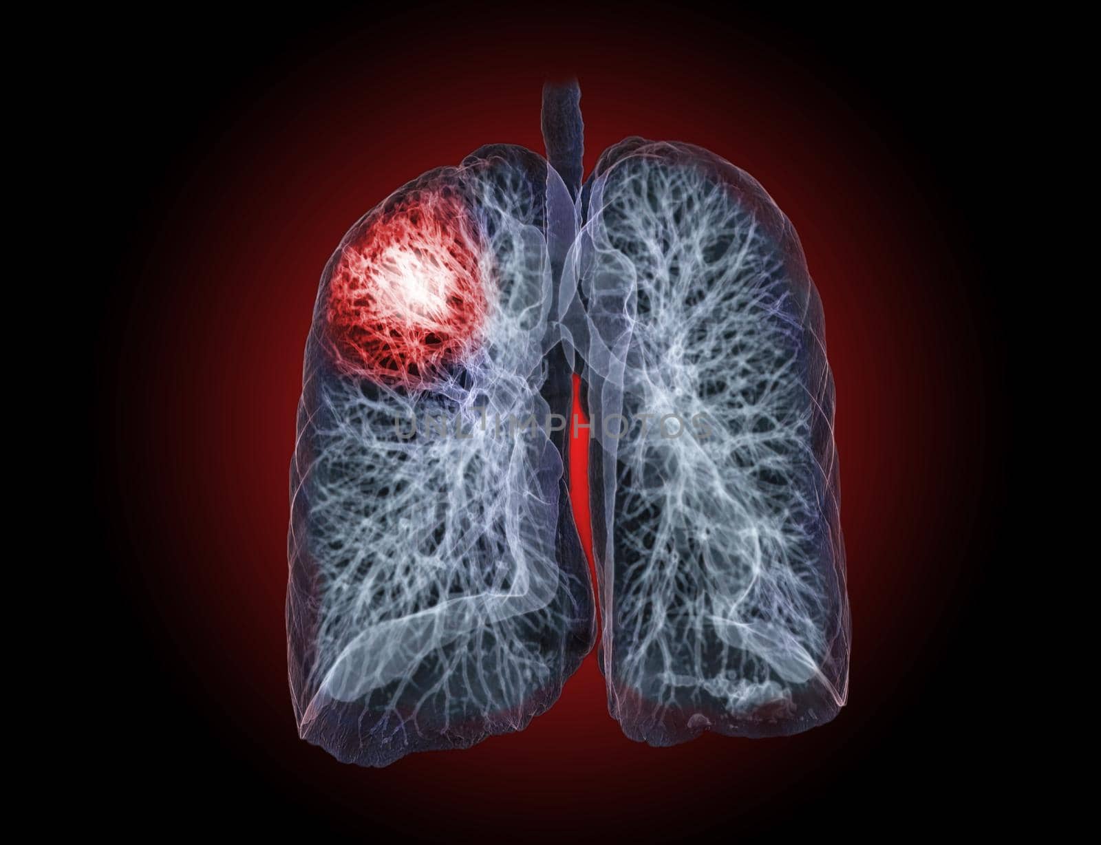 CT Chest or Lung 3D rendering image for diagnosis TB,tuberculosis and covid-19 .