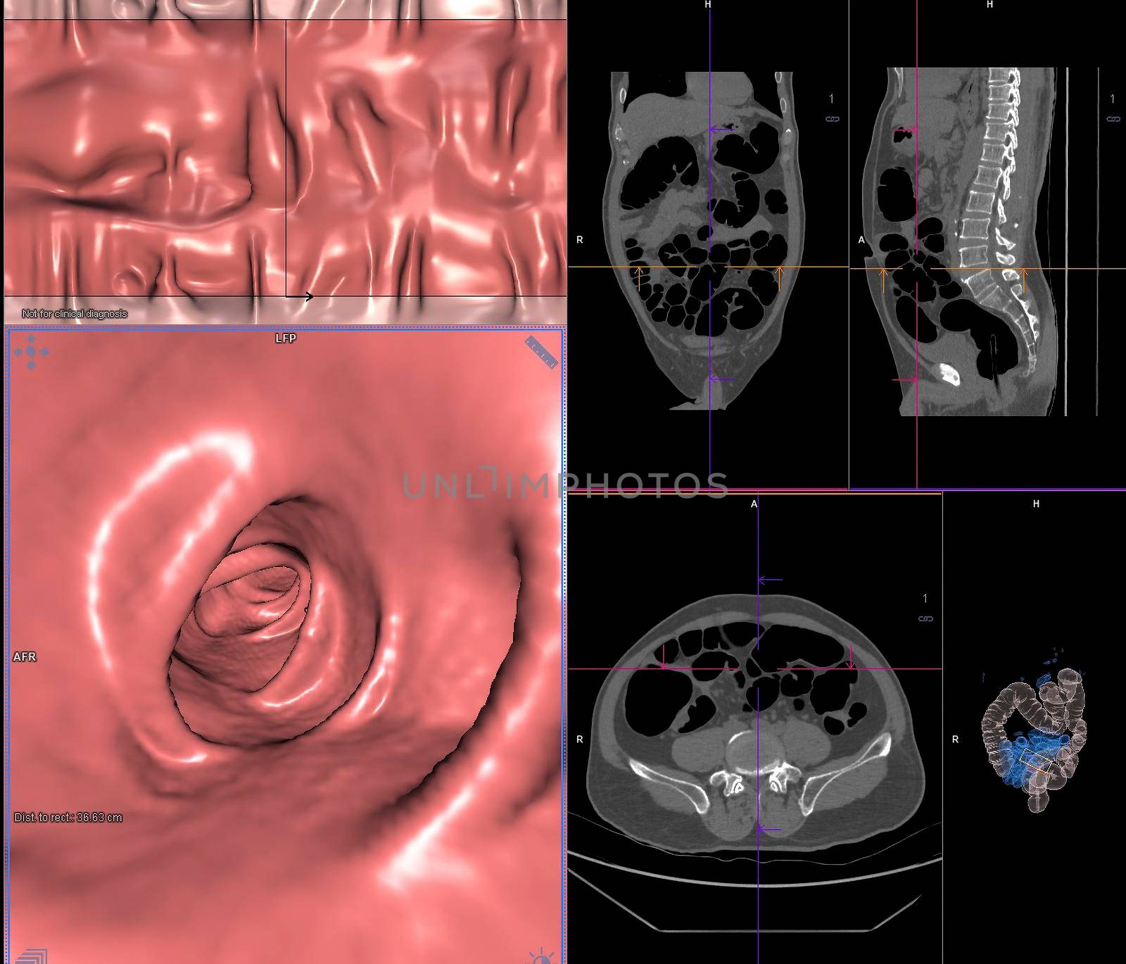 CT colonography or CT Scan of Colon axial view vs Coronal view and 3D rendering image on the screen for diagnosis large bowel cancer.