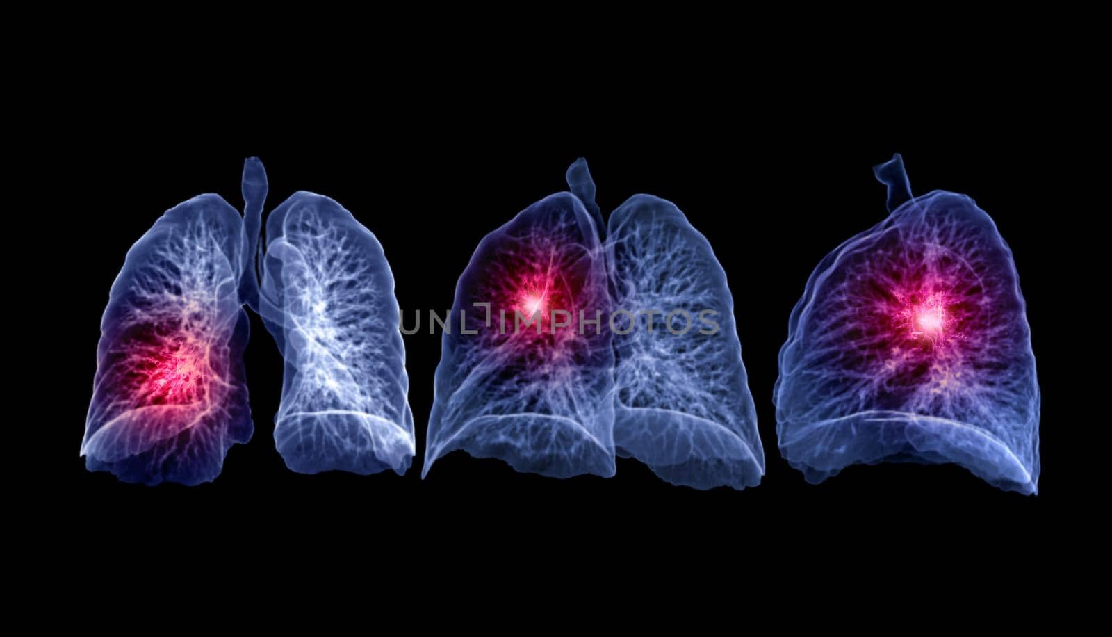 Collection of CT Chest or Lung 3D rendering image showing lesion for diagnosis TB,tuberculosis and covid-19 .