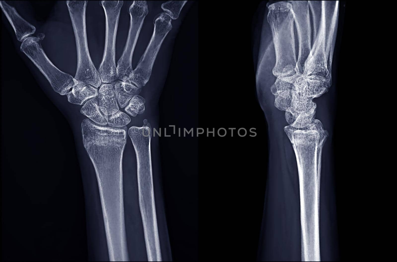 X-ray image of Right wrist joint Ap and Lateral view for diagnosis rheumatoid arthritis .