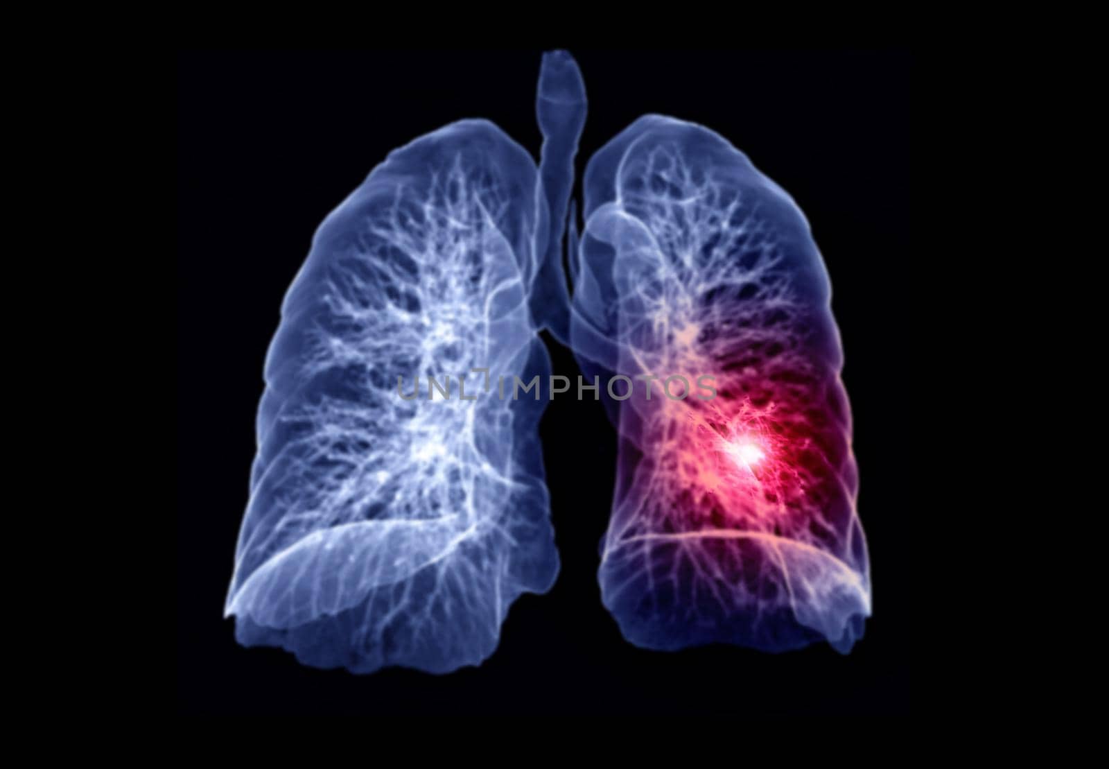 Selective Focus of CT Chest or Lung 3D rendering image showing lesion left area for diagnosis TB,tuberculosis and covid-19 .