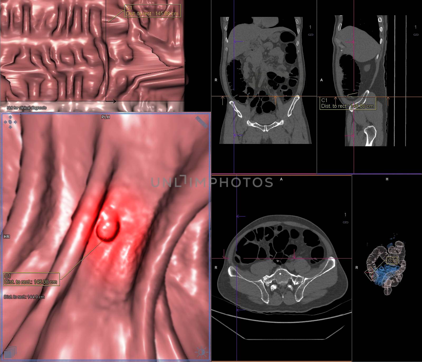 CT colonography or CT Scan of Colon axial view vs Coronal view and 3D rendering image on the screen for diagnosis large bowel cancer.